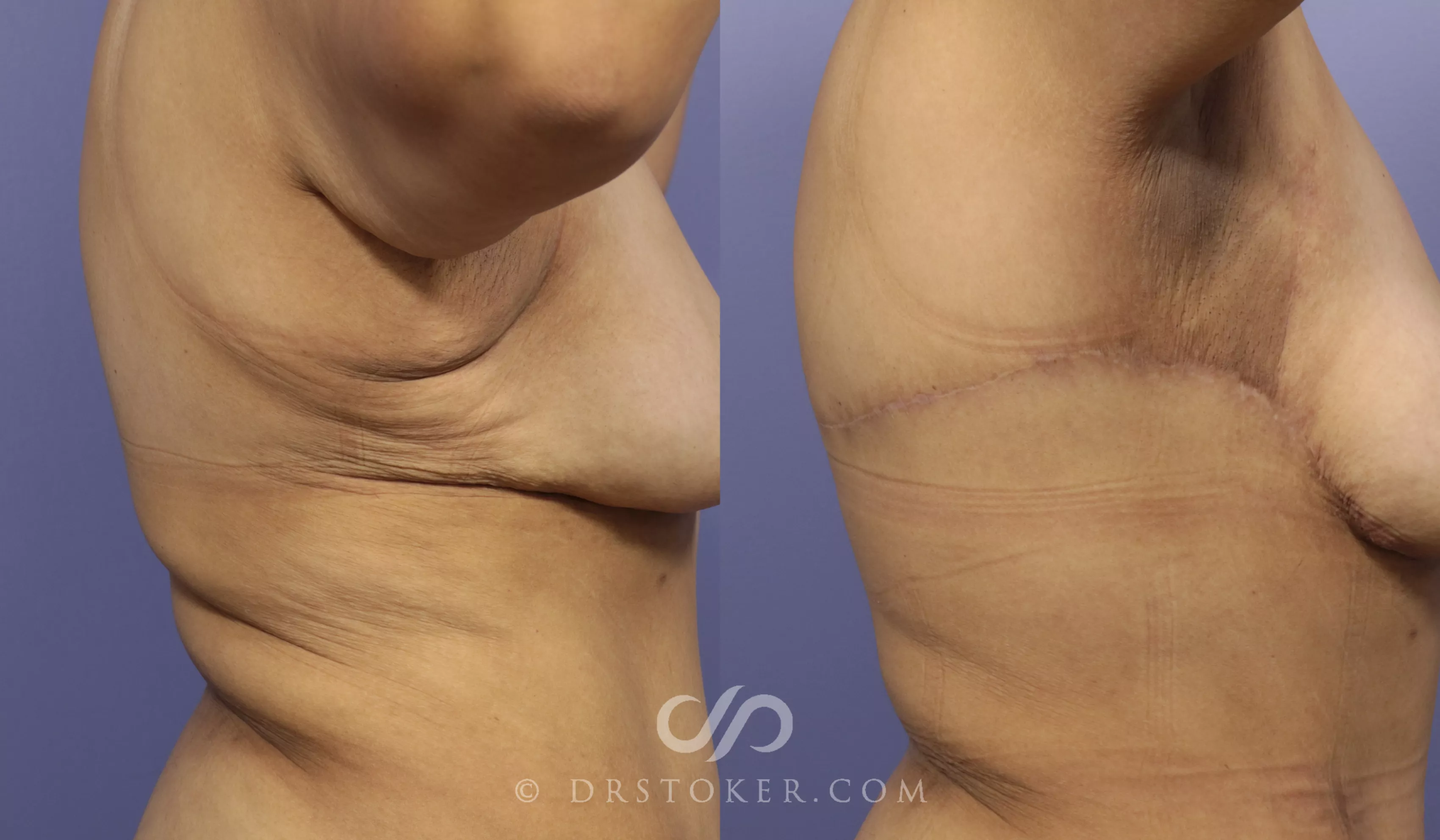 Back Lift (Bra Line Back Lift) Before and After Pictures Case 1093, Los  Angeles, CA