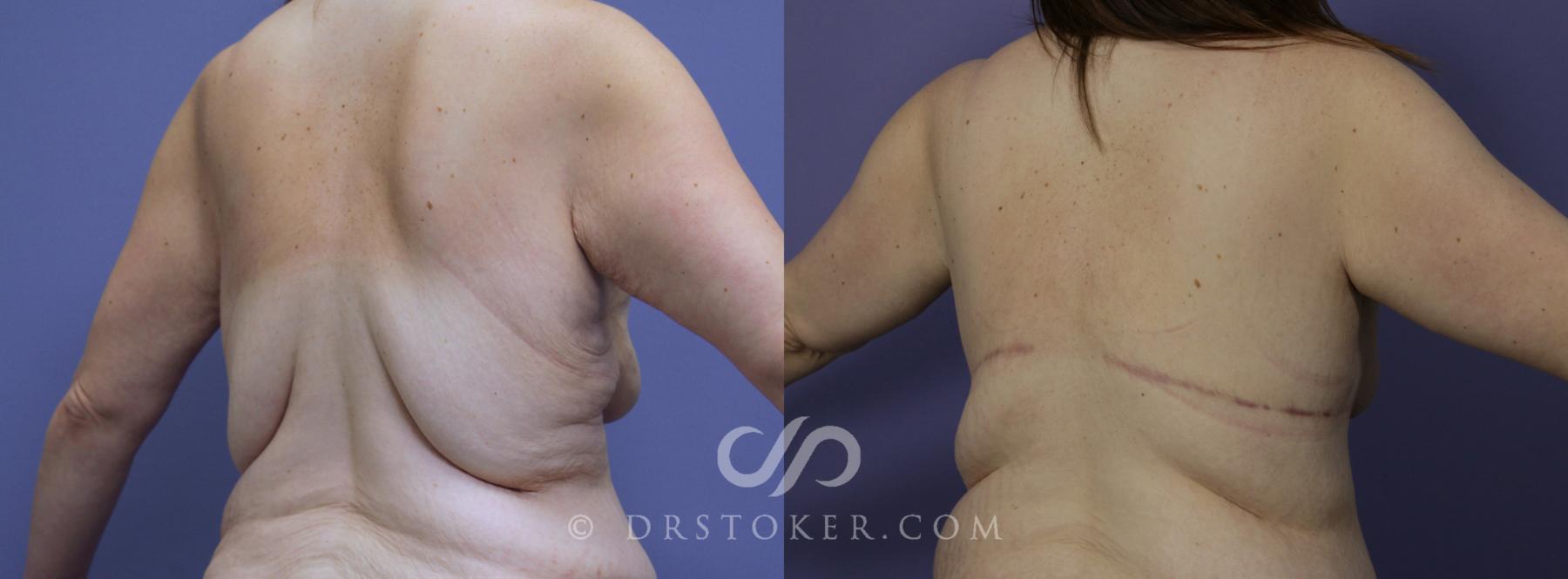 Before & After Back Lift (Bra Line Back Lift) Case 1095 View #1 View in Los Angeles, CA