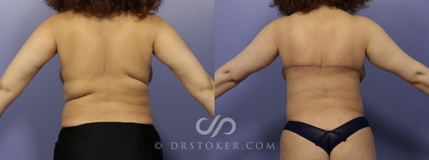 Before & After Back Lift (Bra Line Back Lift) Case 1096 View #1 View in Los Angeles, CA