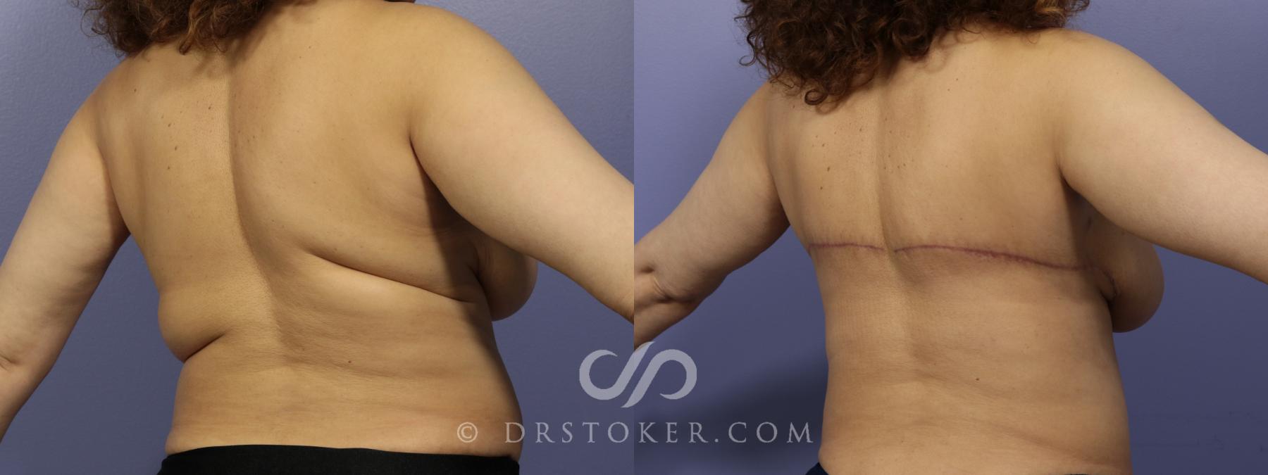 Before & After Back Lift (Bra Line Back Lift) Case 1096 View #2 View in Los Angeles, CA