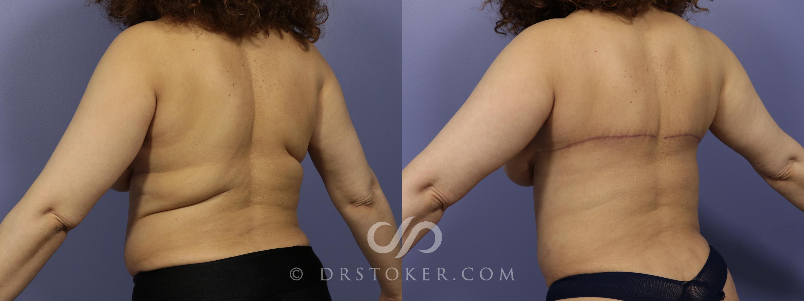 Before & After Back Lift (Bra Line Back Lift) Case 1096 View #3 View in Los Angeles, CA