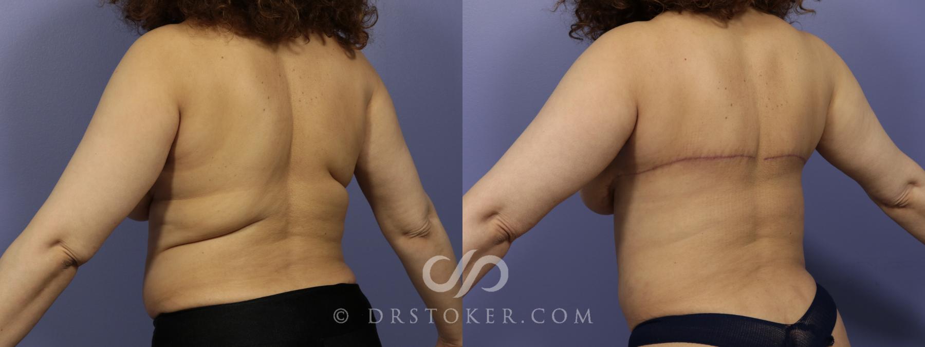 Bra Line Back Lift Before and After