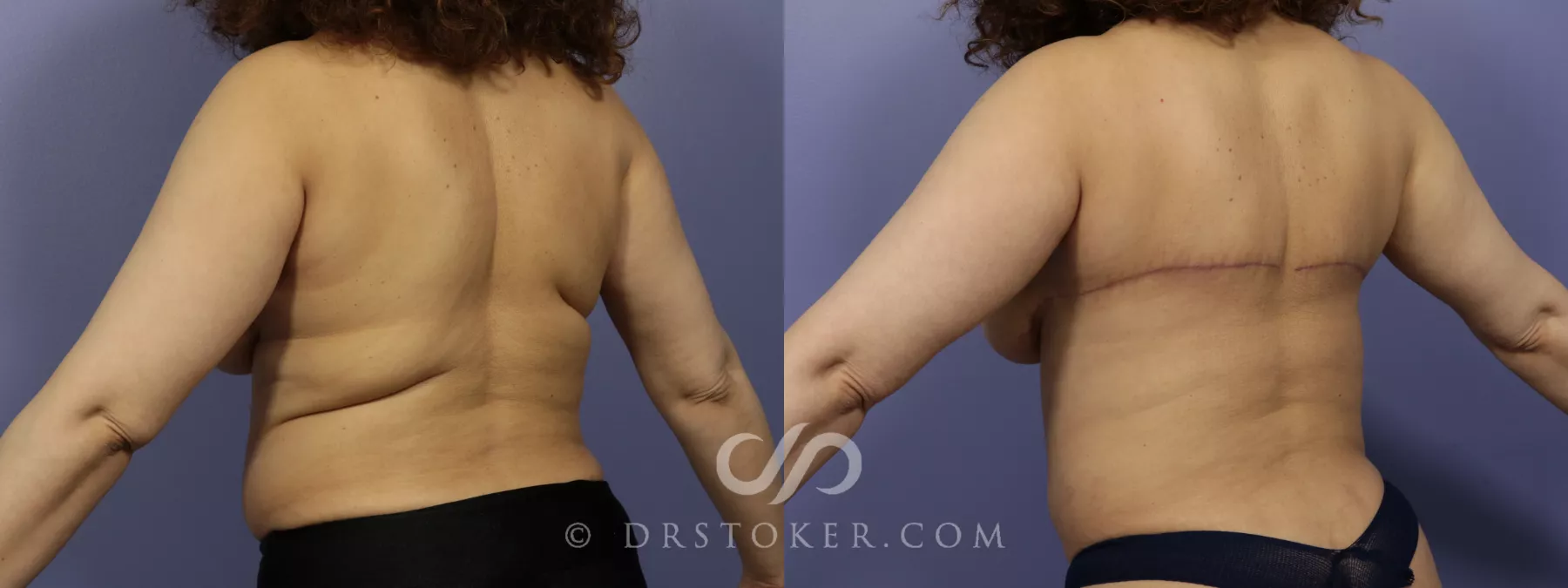 Patient #17574 Bra Line Lift Before and After Photos Pittsburgh