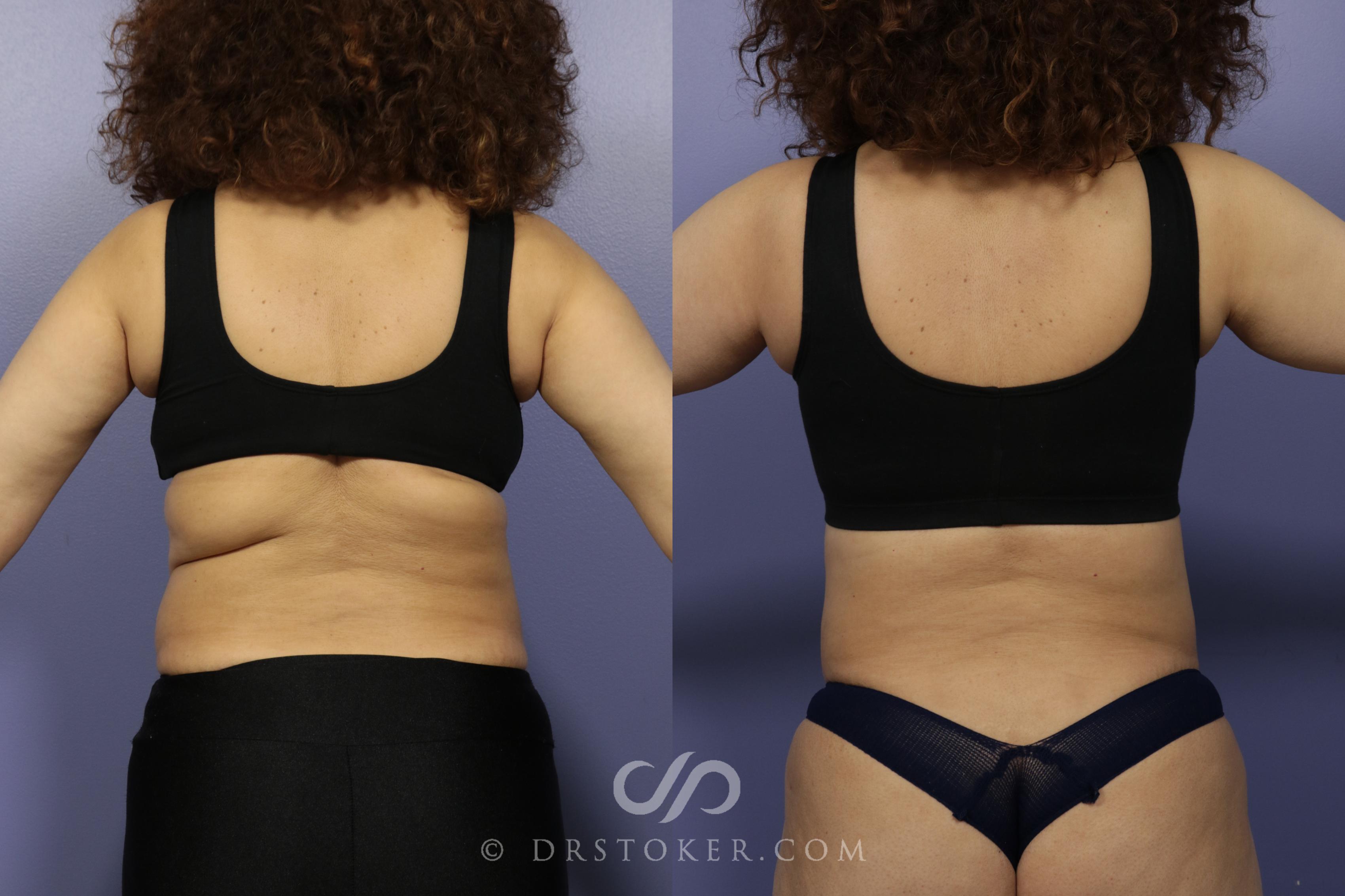 Before & After Back Lift (Bra Line Back Lift) Case 1097 View #1 View in Los Angeles, CA