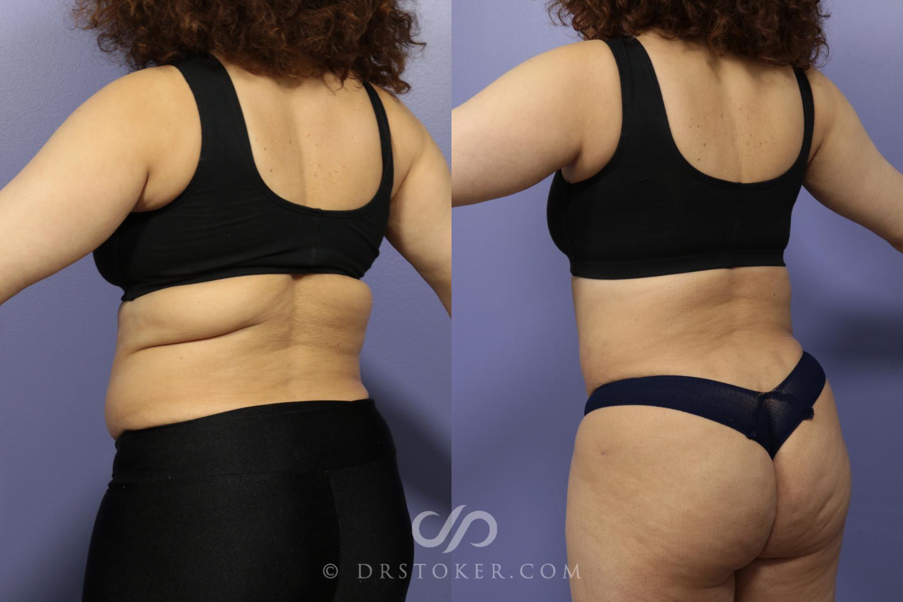 Back Lift (Bra Line Back Lift) Before and After Pictures Case 1097