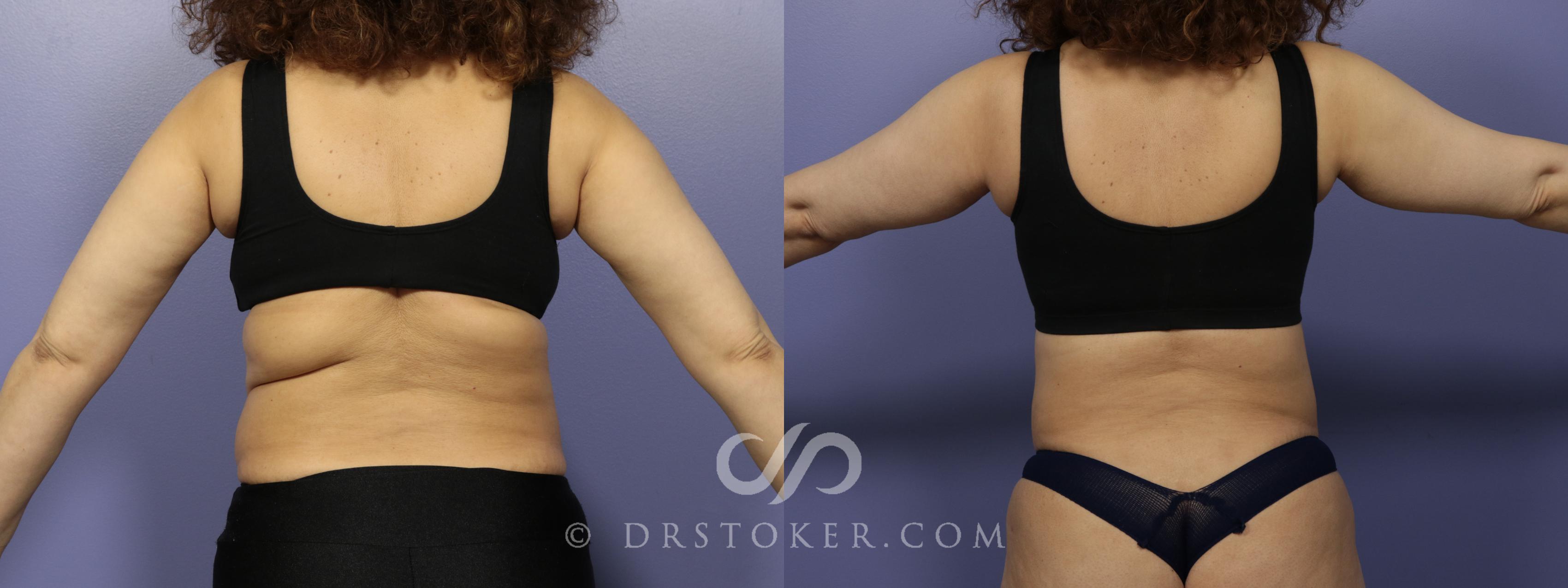Before & After Back Lift (Bra Line Back Lift) Case 1099 View #1 View in Marina del Rey, CA