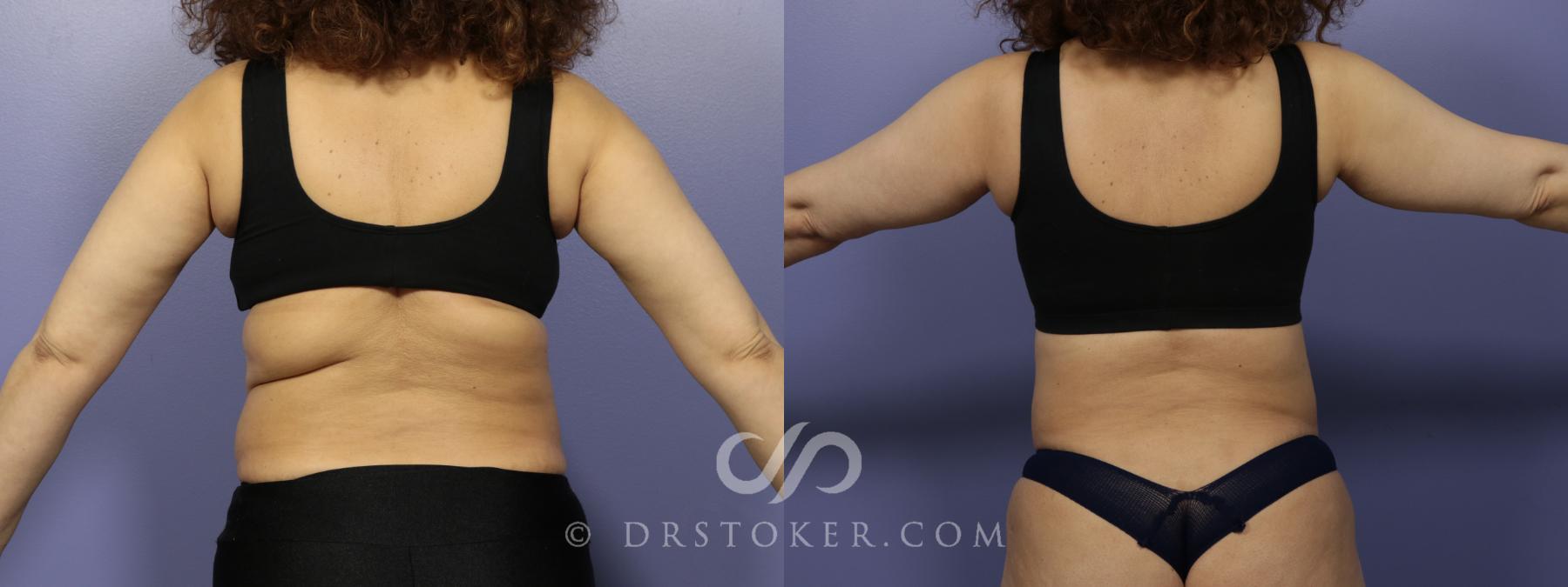 Before & After Back Lift (Bra Line Back Lift) Case 1099 View #1 View in Los Angeles, CA