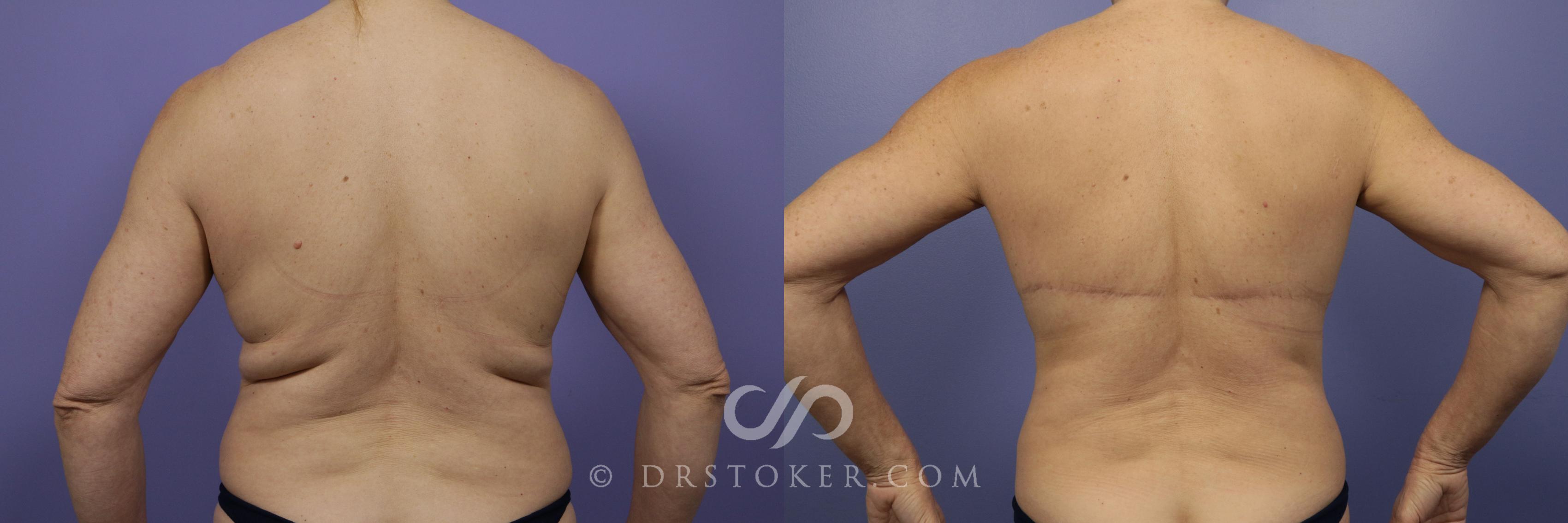 Back Lift (Upper Body Lift) Before and After Pictures Case 11684, Golden,  CO