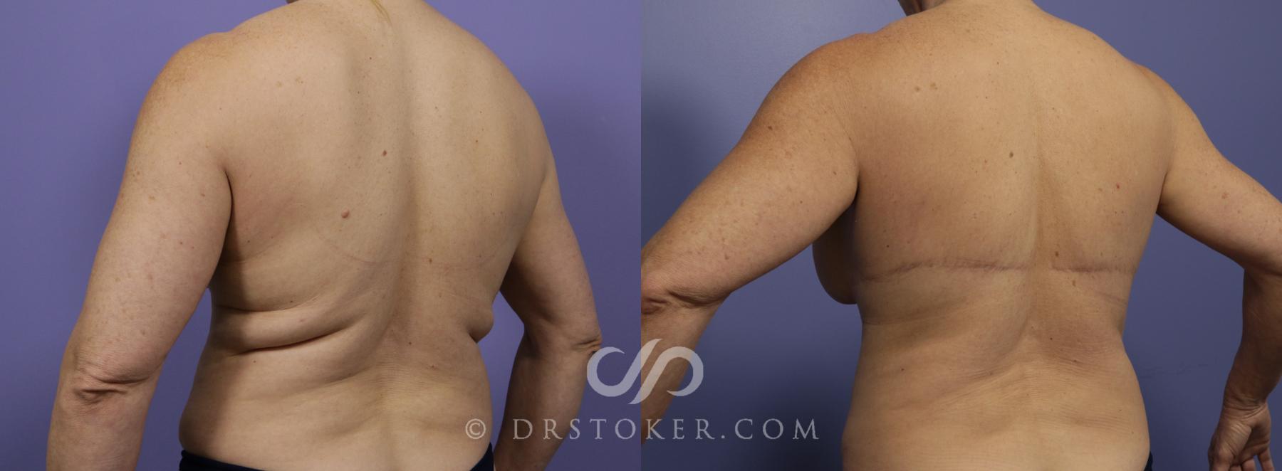 Before & After Back Lift (Bra Line Back Lift) Case 1101 View #2 View in Los Angeles, CA