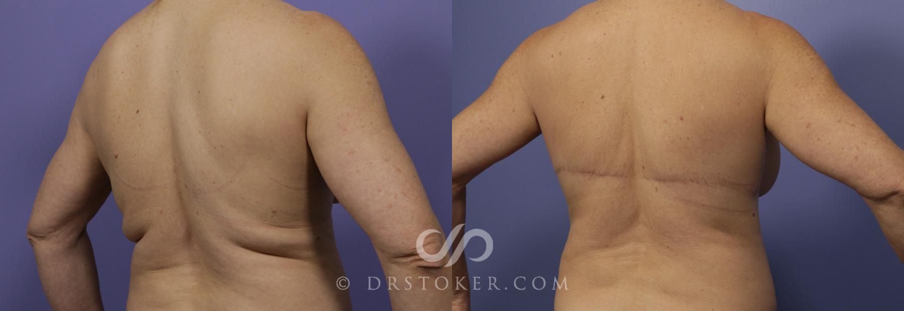 Before & After Back Lift (Bra Line Back Lift) Case 1101 View #3 View in Los Angeles, CA