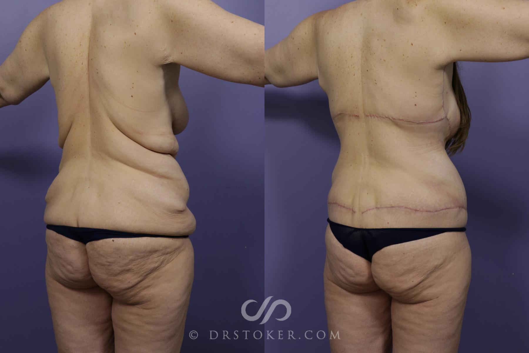 Before & After Back Lift (Bra Line Back Lift) Case 1255 View #2 View in Los Angeles, CA