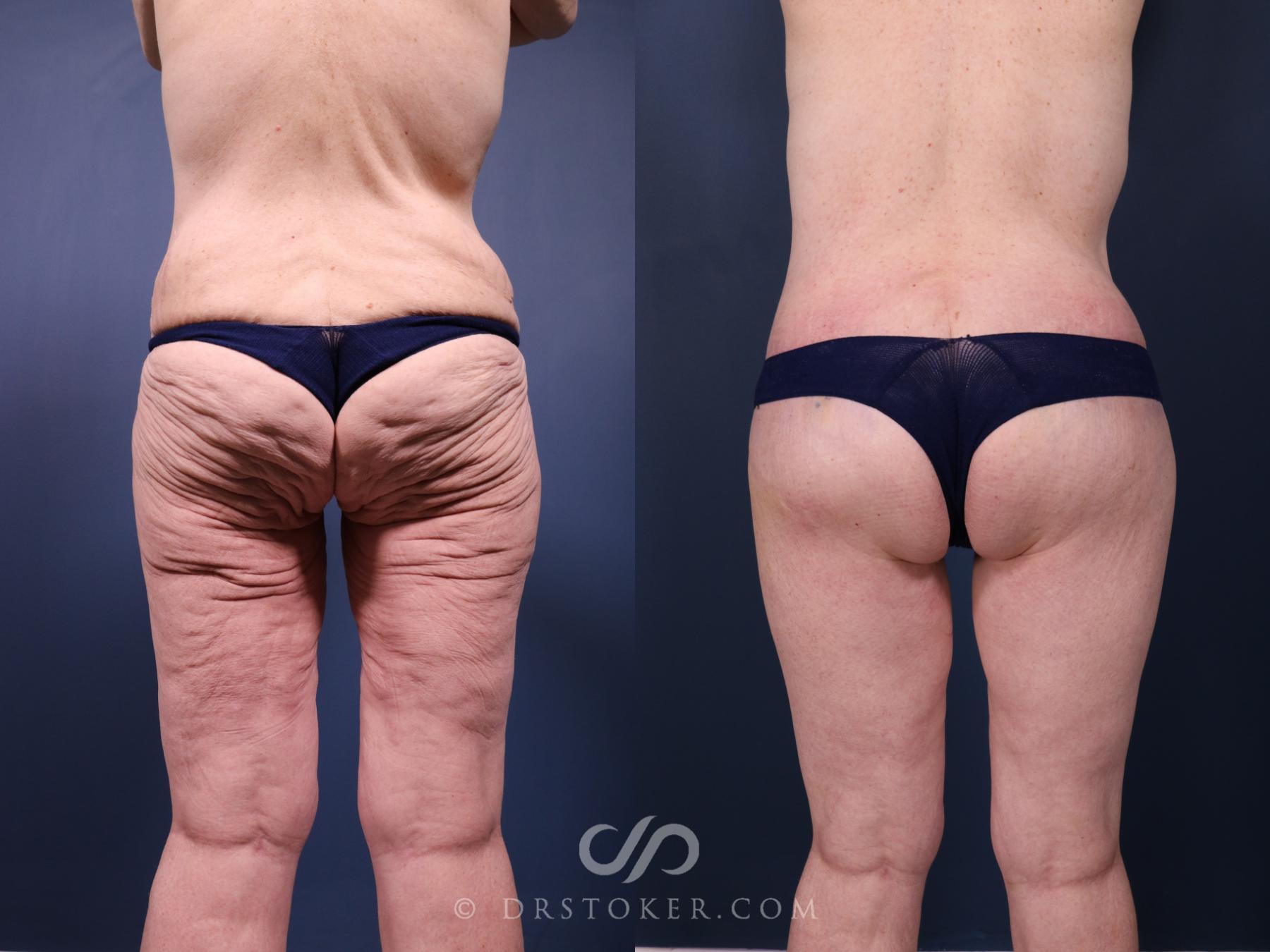 Before & After Bikini Body Lift ™ Case 2415 Back View in Los Angeles, CA