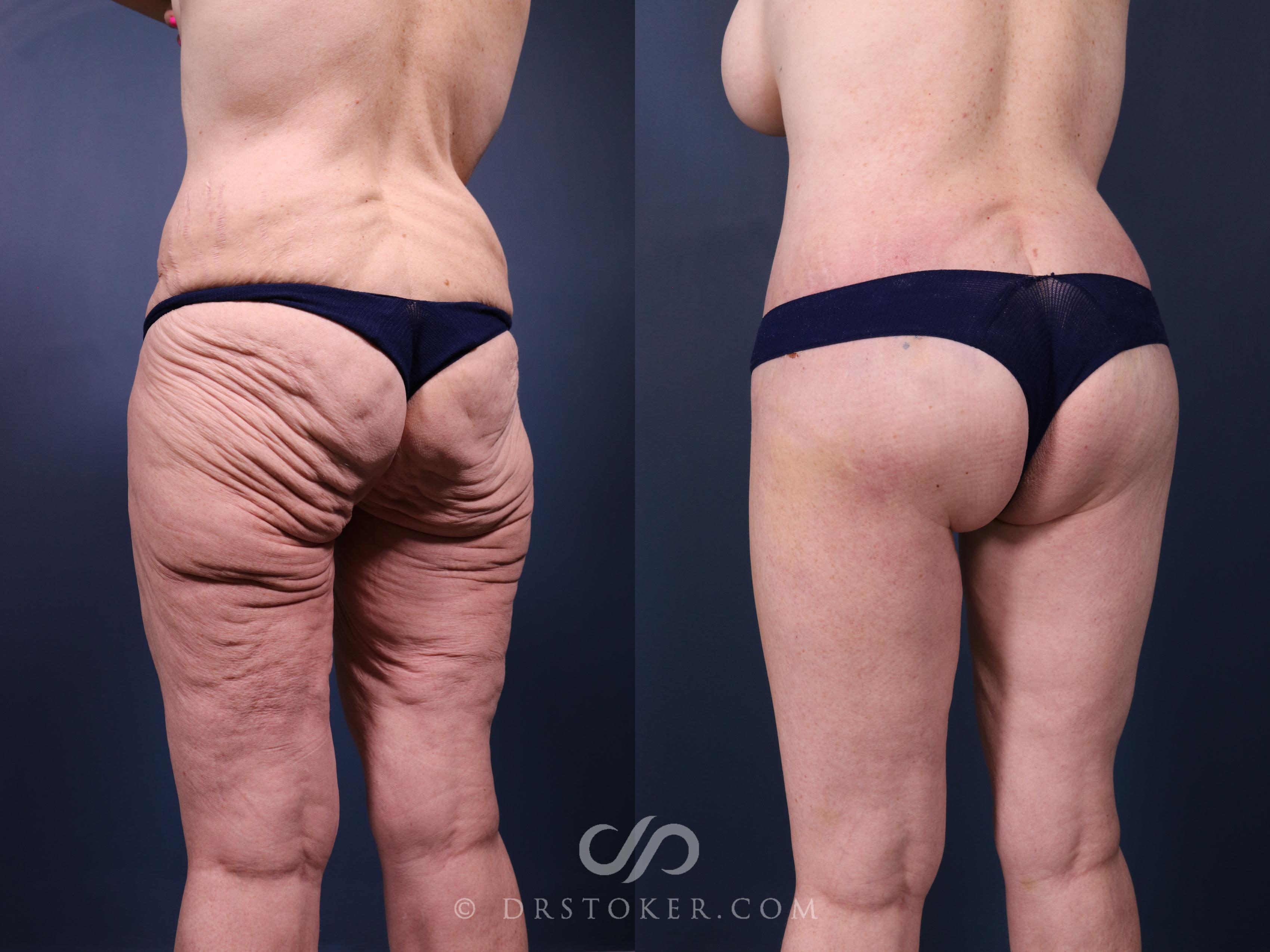 Before & After Bikini Body Lift ™ Case 2415 Left Oblique View in Los Angeles, CA