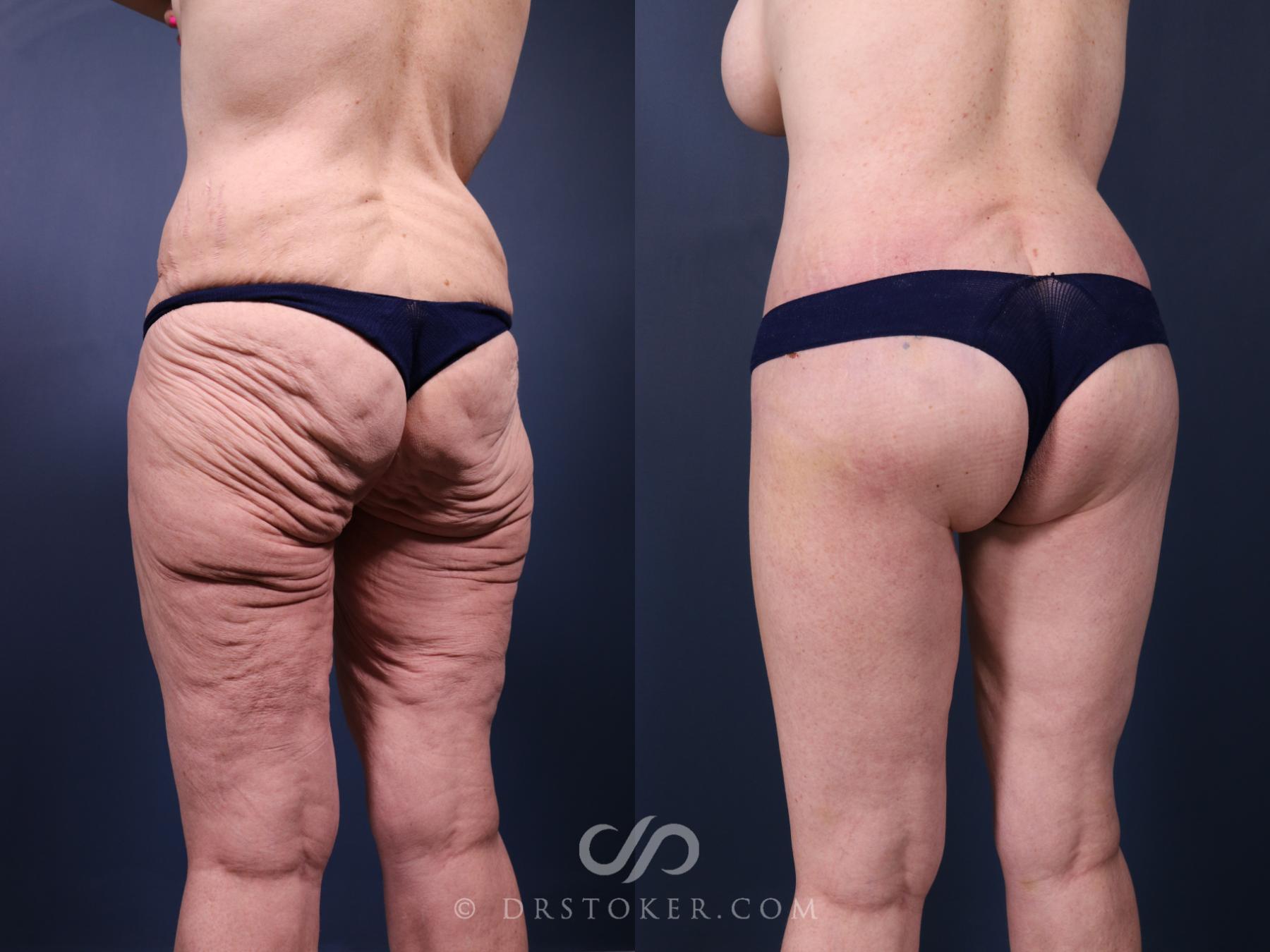 Before & After Bikini Body Lift ™ Case 2415 Left Oblique View in Los Angeles, CA