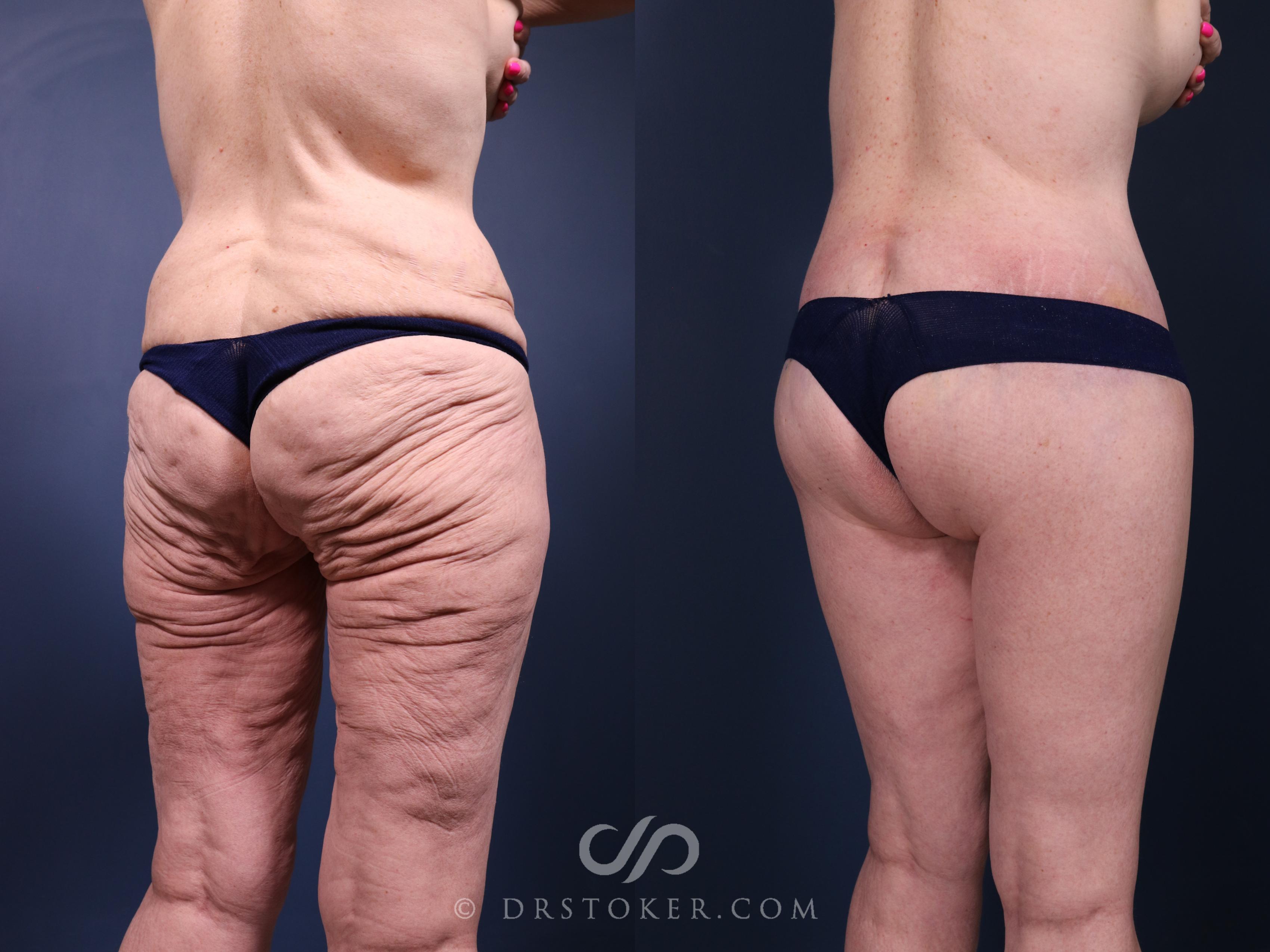 Before & After Bikini Body Lift ™ Case 2415 Right Oblique View in Los Angeles, CA