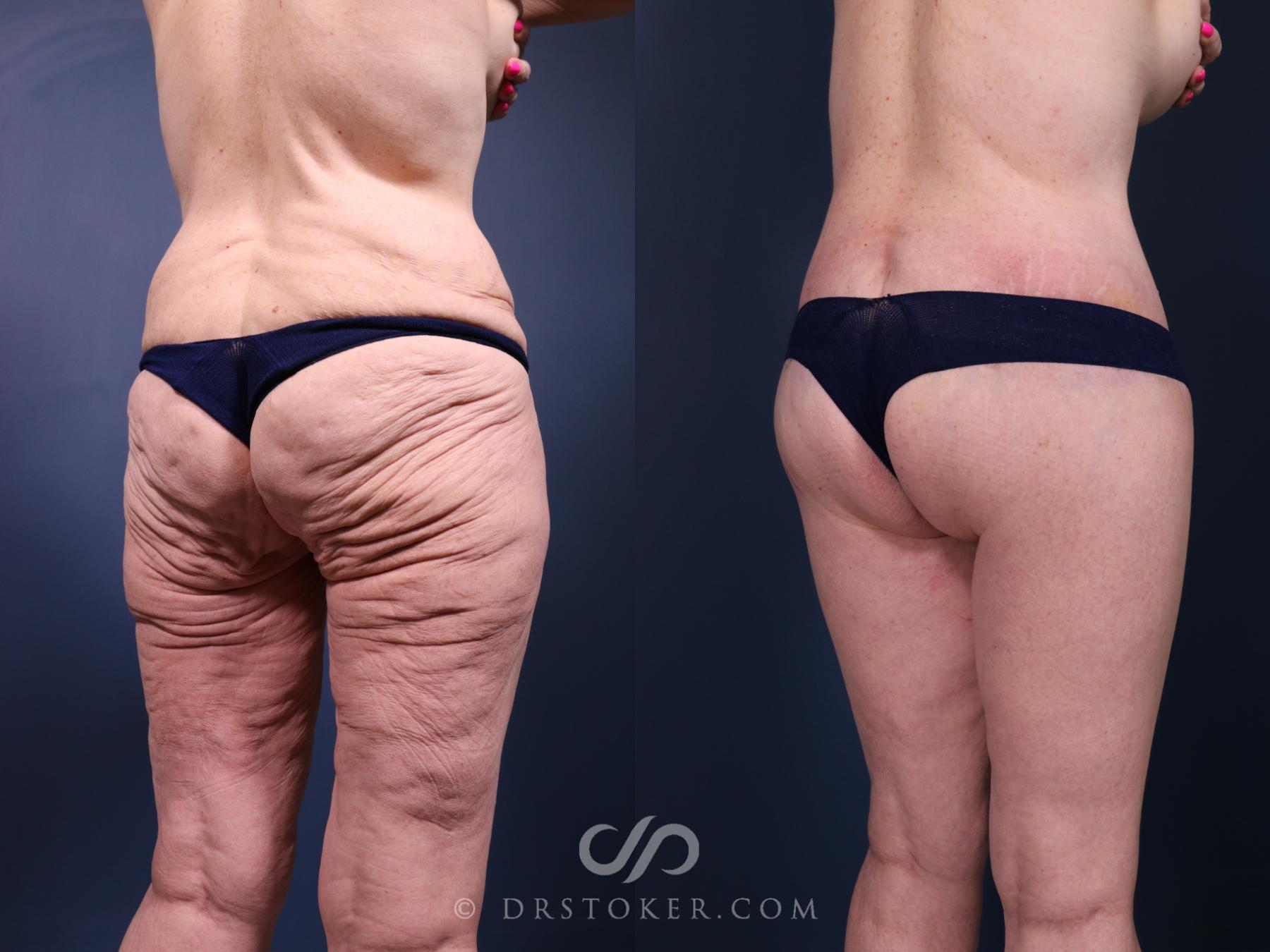 Before & After Bikini Body Lift ™ Case 2415 Right Oblique View in Los Angeles, CA