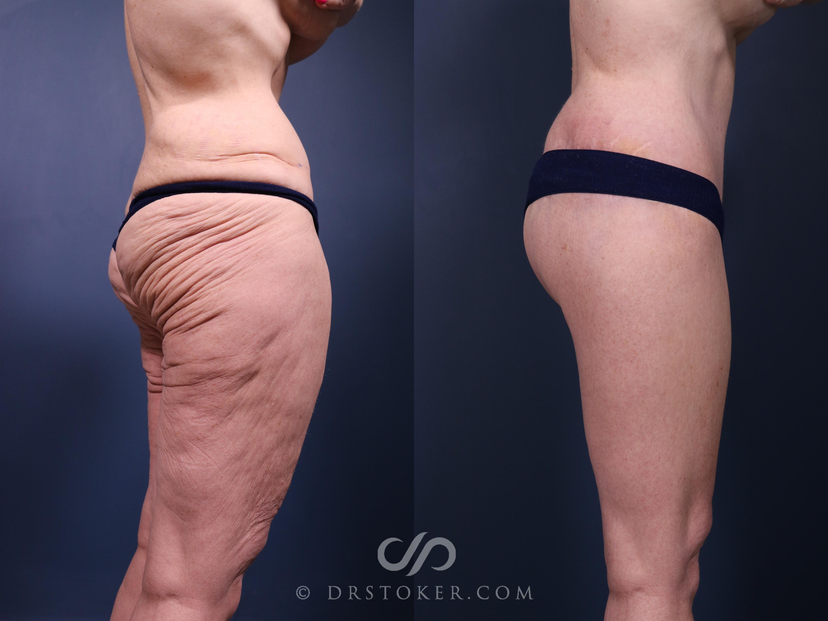 Before & After Bikini Body Lift ™ Case 2415 Right Side View in Los Angeles, CA