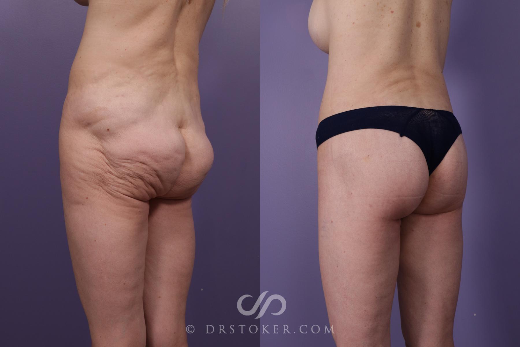 Before & After Bikini Body Lift ™ Case 2416 Left Oblique View in Los Angeles, CA