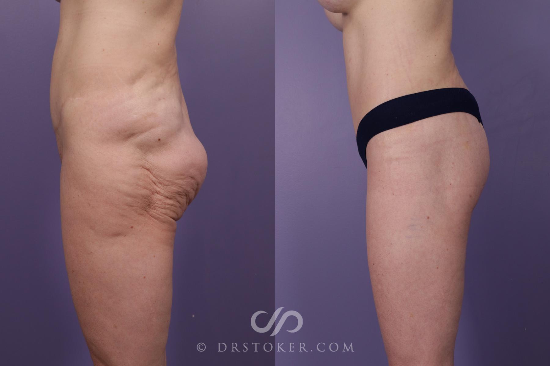 Before & After Bikini Body Lift ™ Case 2416 Left Side View in Los Angeles, CA