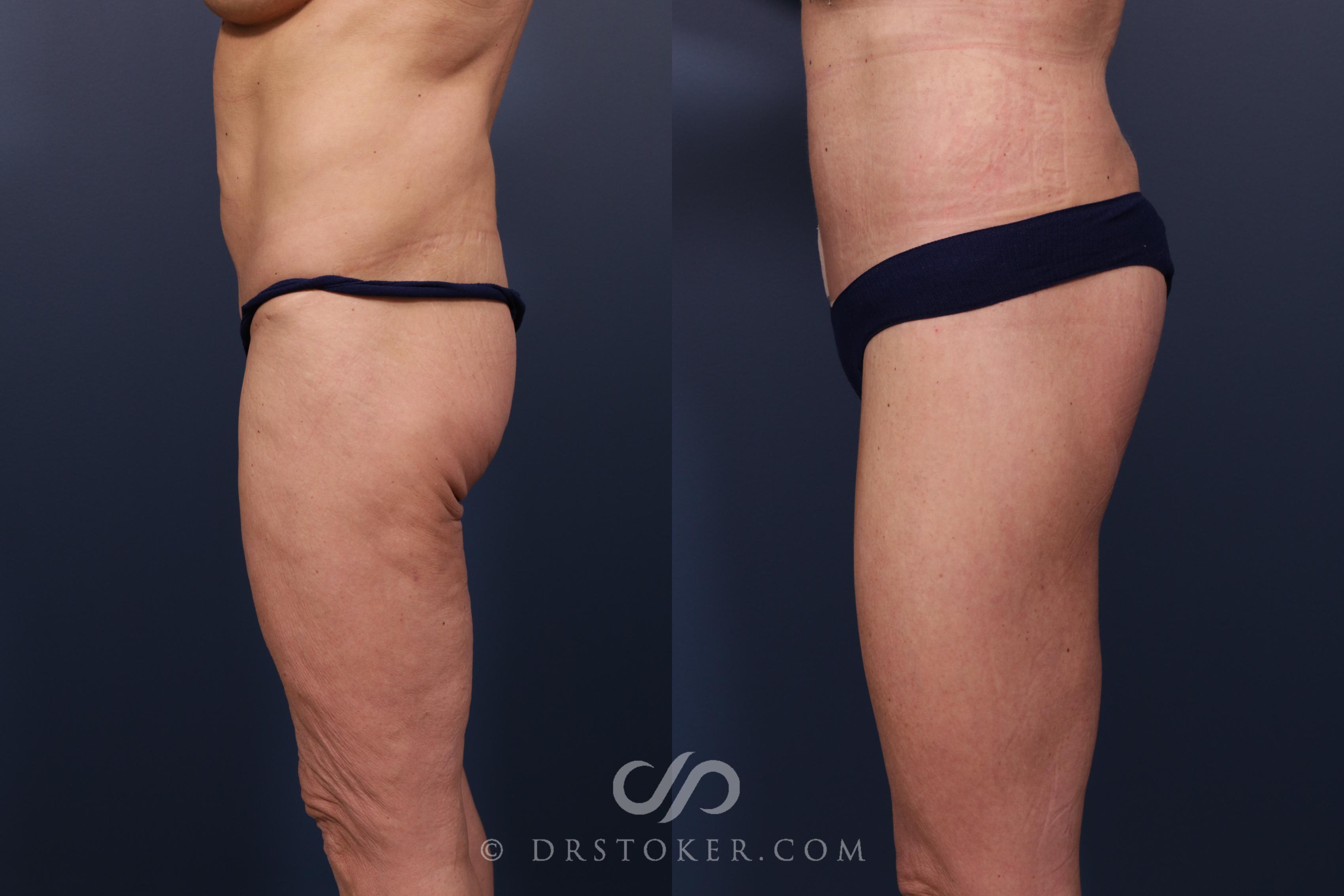 Before & After Bikini Body Lift ™ Case 2417 Left Side View in Los Angeles, CA