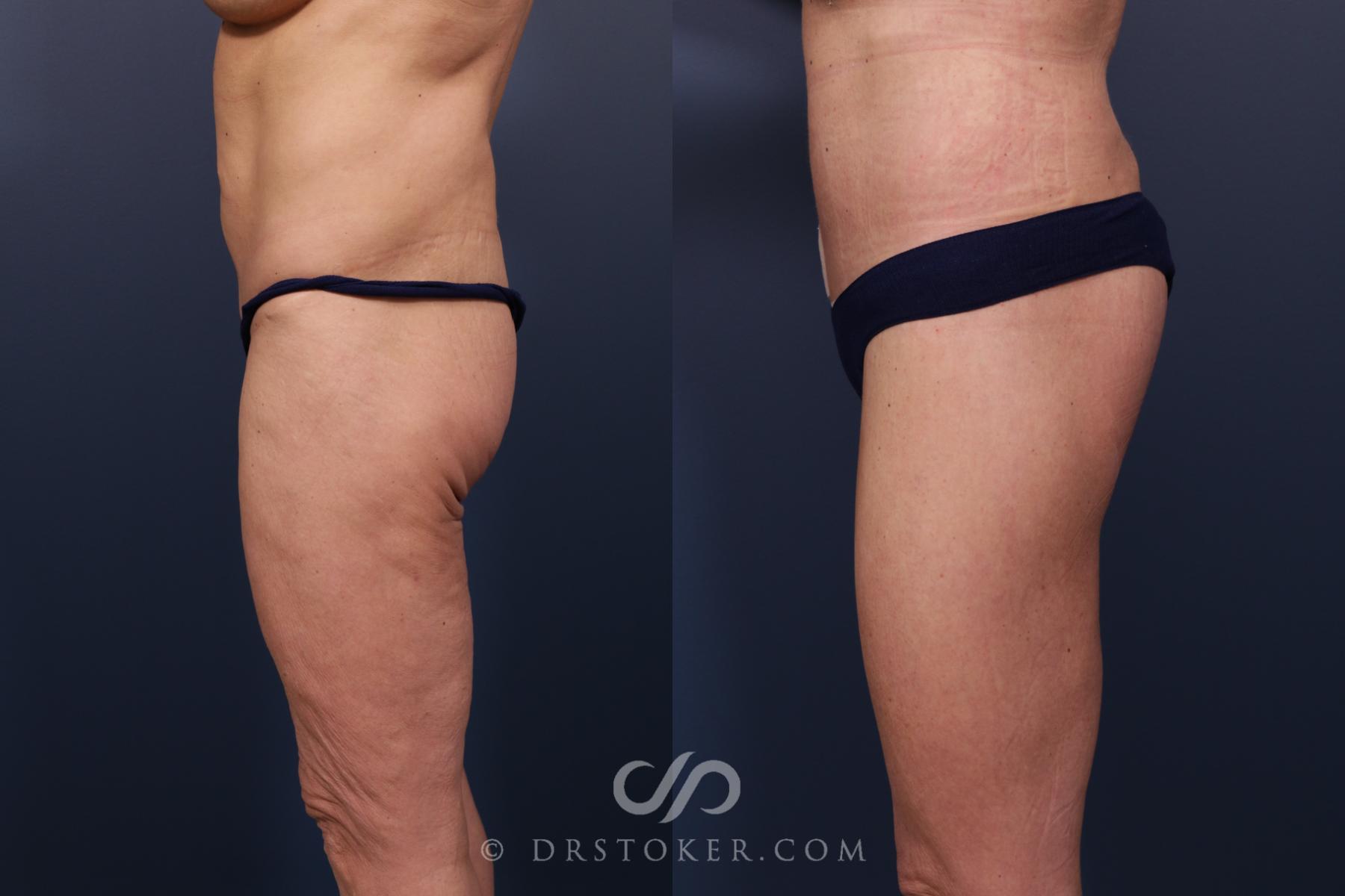 Before & After Bikini Body Lift ™ Case 2417 Left Side View in Los Angeles, CA