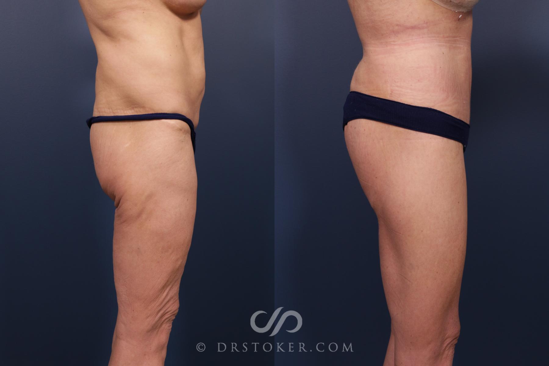 Before & After Bikini Body Lift ™ Case 2417 Right Side View in Los Angeles, CA