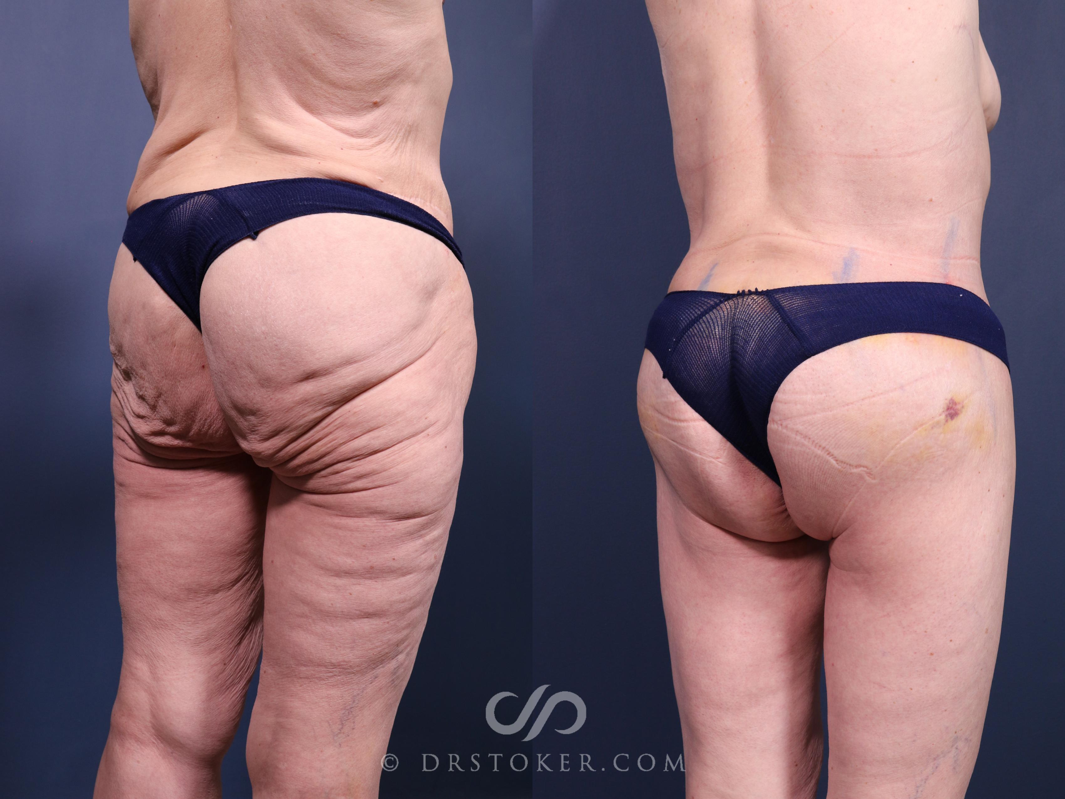 Before & After Bikini Body Lift ™ Case 2418 Right Oblique View in Los Angeles, CA