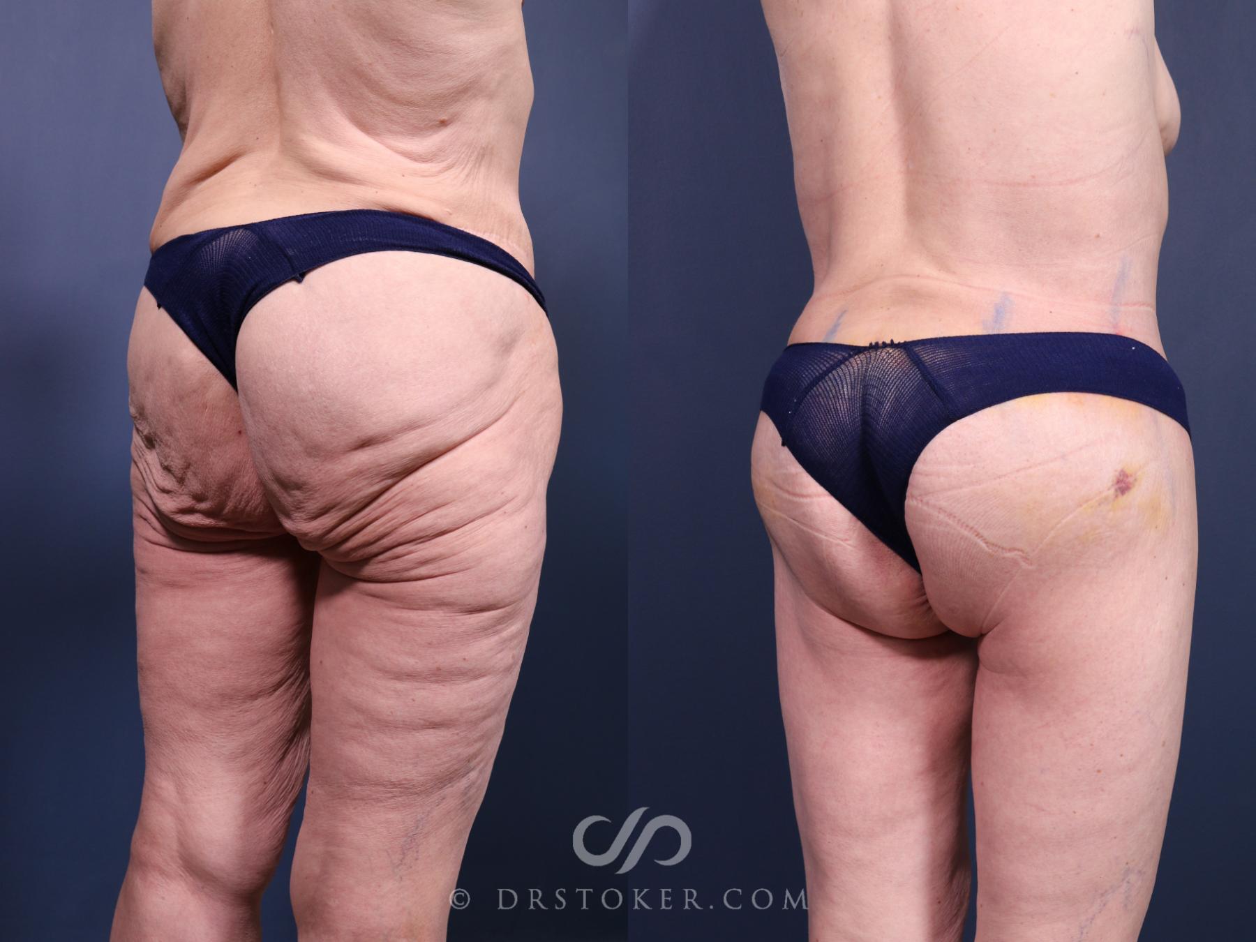 Before & After Bikini Body Lift ™ Case 2418 Right Oblique View in Los Angeles, CA
