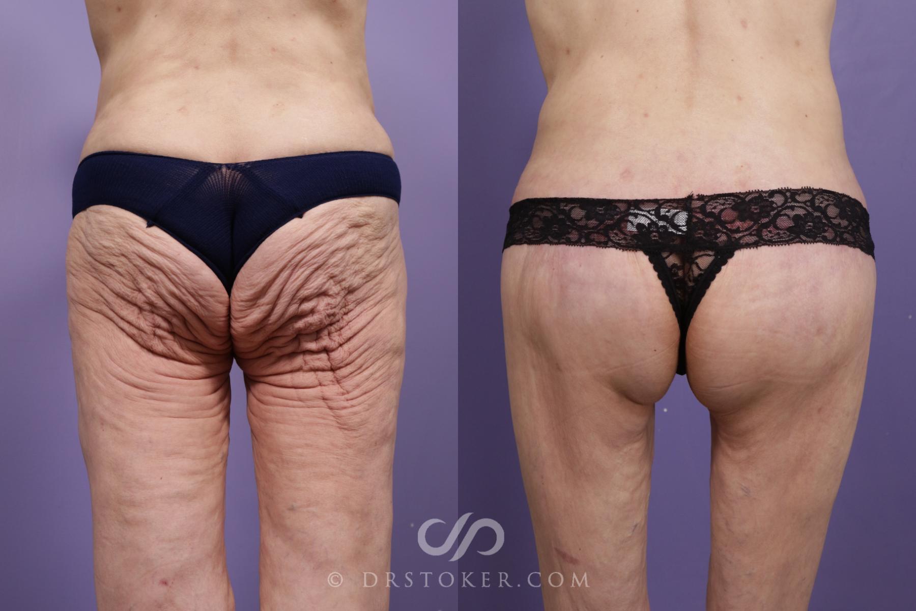 Before & After Bikini Body Lift ™ Case 2419 Back View in Los Angeles, CA