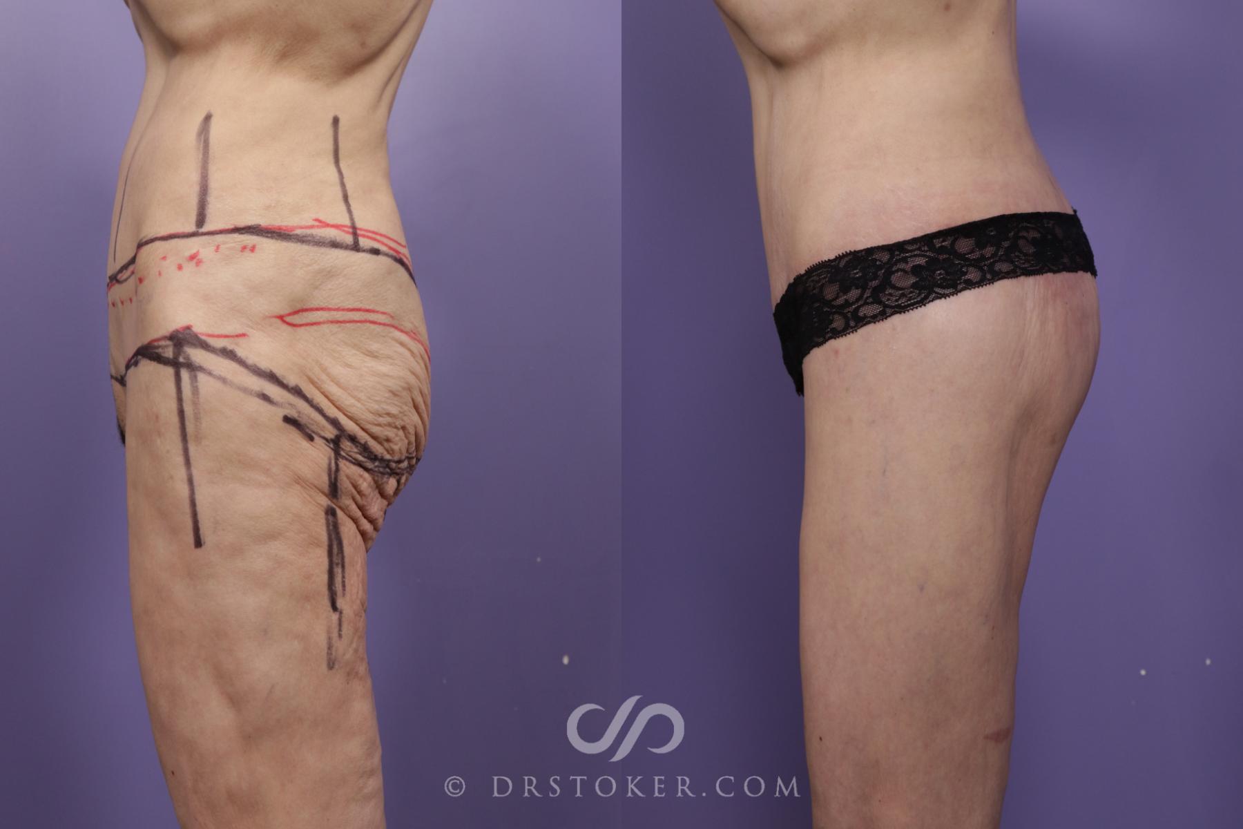 Before & After Bikini Body Lift ™ Case 2419 Left Side View in Los Angeles, CA