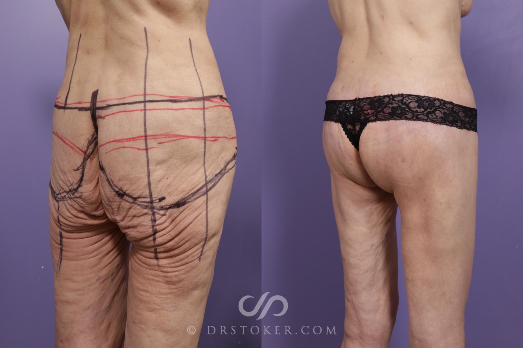 Before & After Bikini Body Lift ™ Case 2419 Right Oblique View in Los Angeles, CA