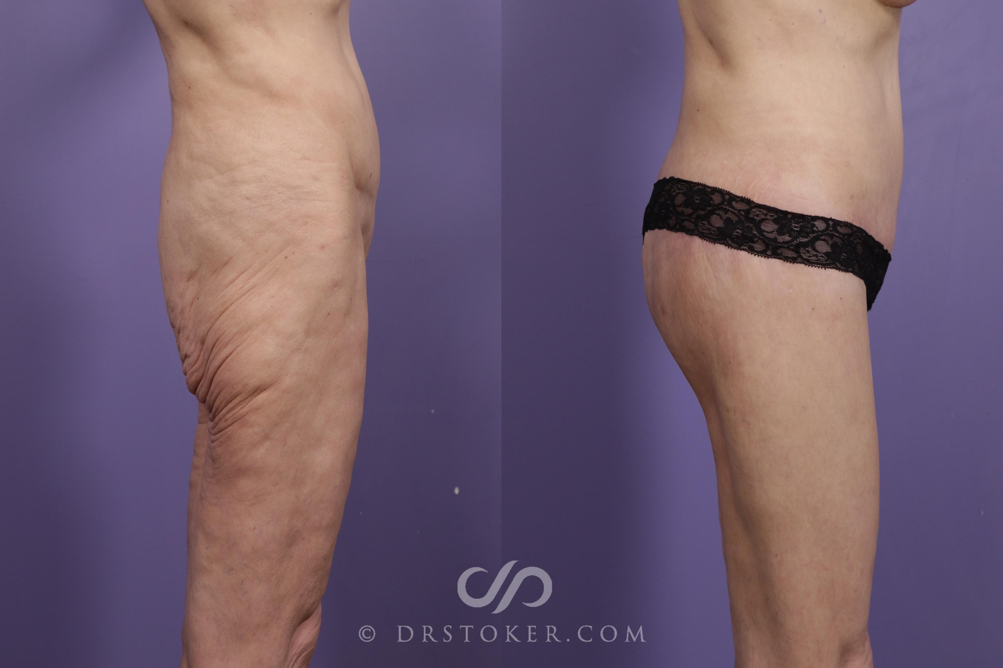 Before & After Bikini Body Lift ™ Case 2419 Right Side View in Los Angeles, CA