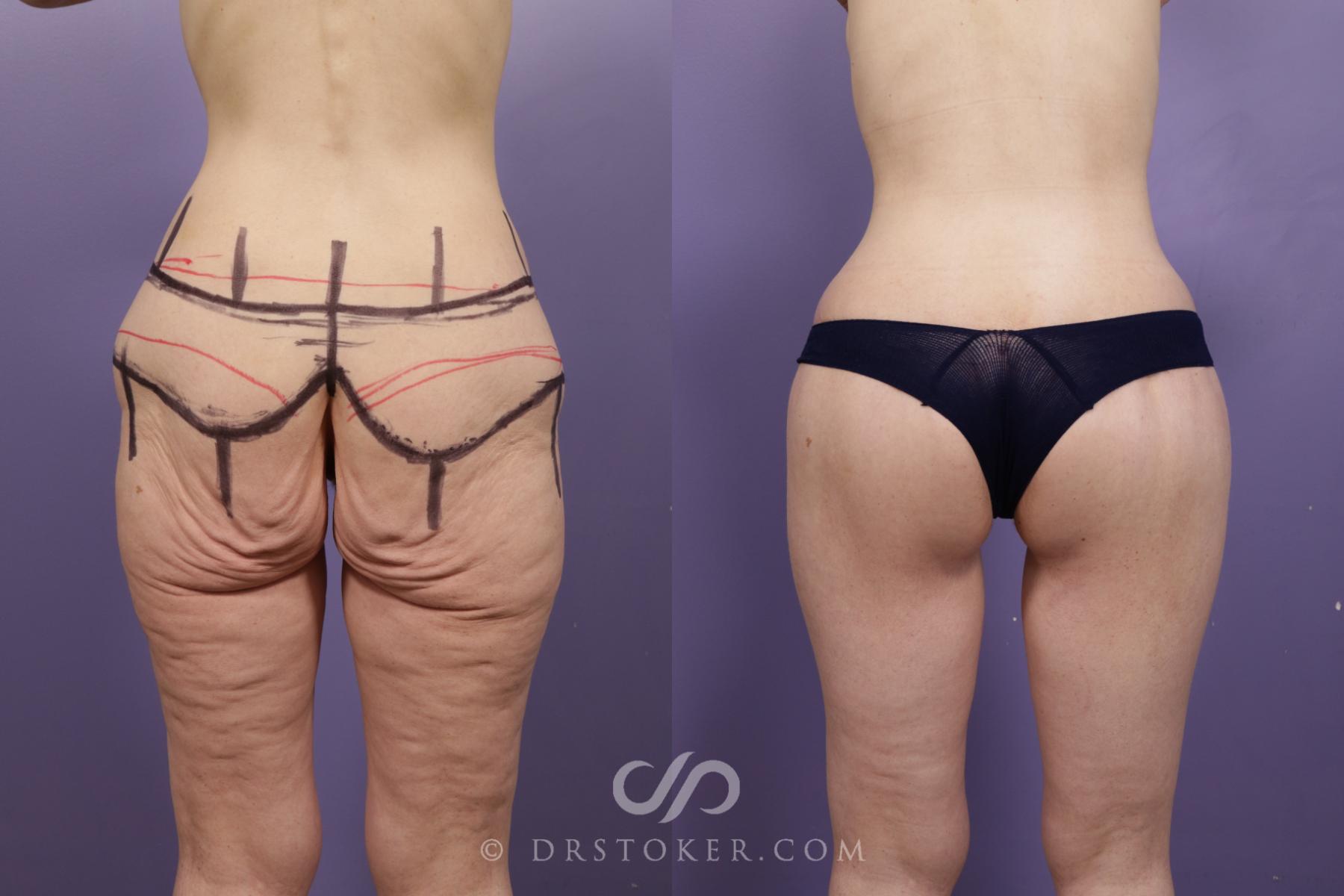 Before & After Bikini Body Lift ™ Case 2420 Back View in Los Angeles, CA