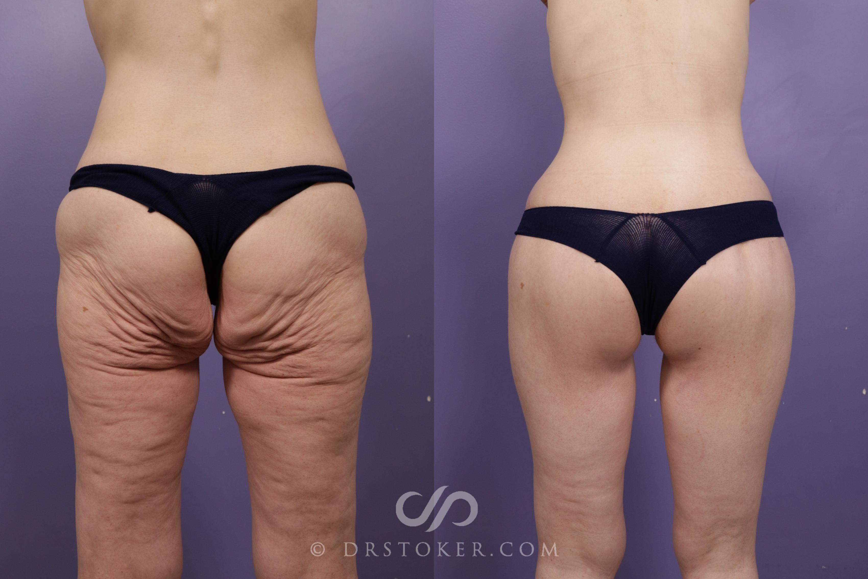Before & After Bikini Body Lift ™ Case 2420 Back w/o markings View in Los Angeles, CA