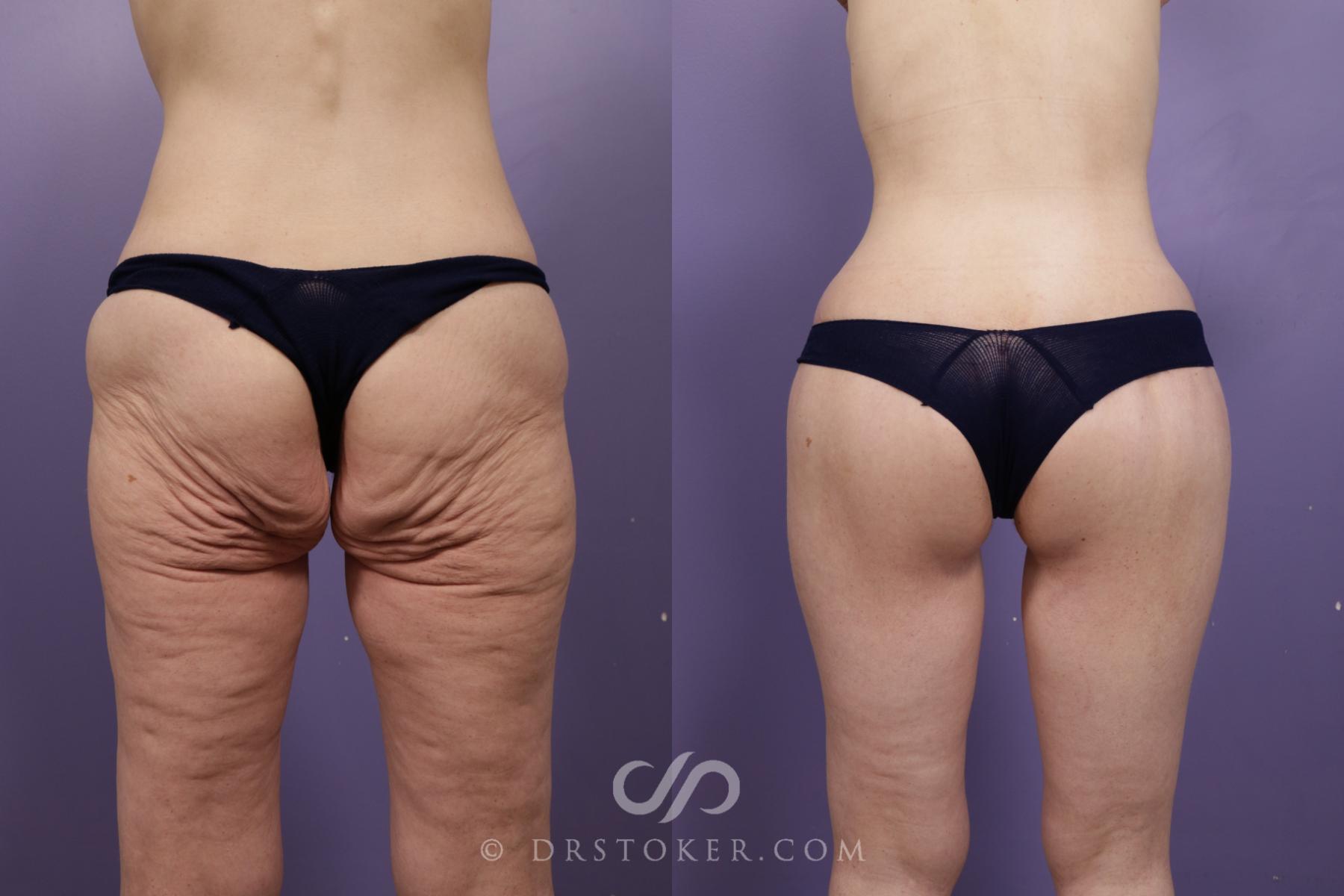 Before & After Bikini Body Lift ™ Case 2420 Back w/o markings View in Los Angeles, CA