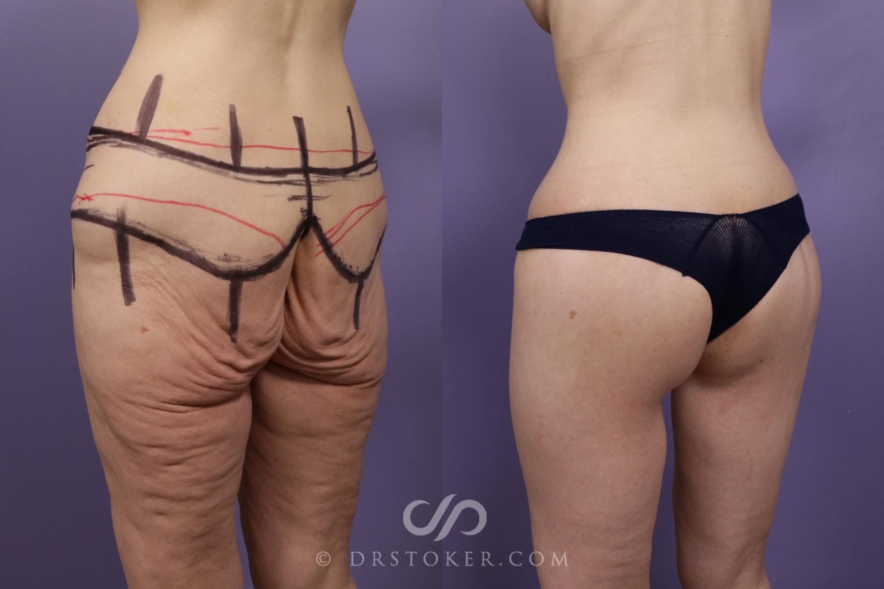 Before & After Bikini Body Lift ™ Case 2420 Left Oblique View in Los Angeles, CA