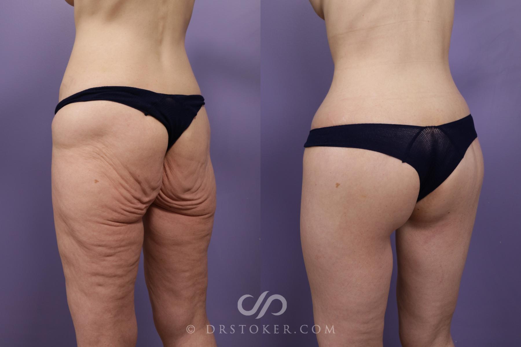 Before & After Bikini Body Lift ™ Case 2420 Left oblique w/o markings View in Los Angeles, CA
