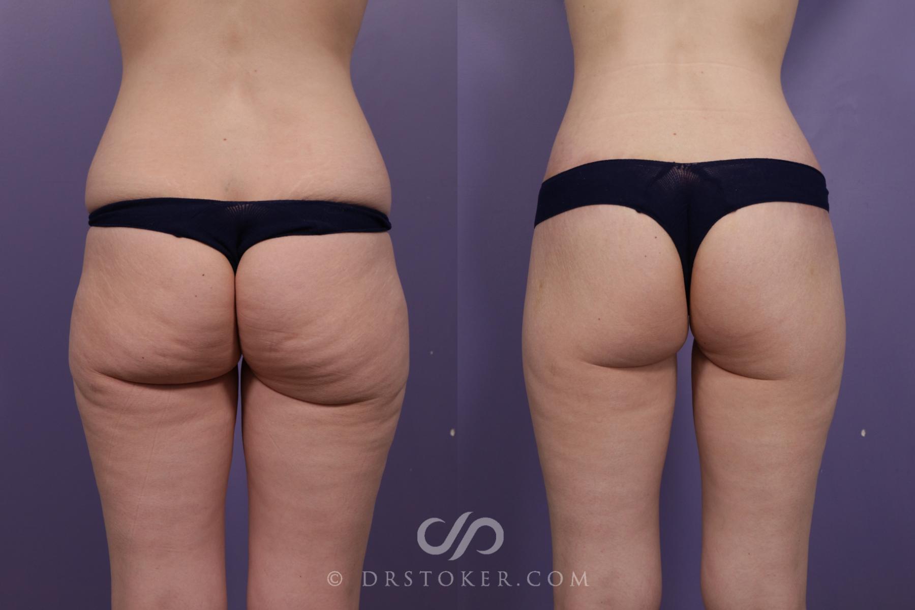Before & After Bikini Body Lift ™ Case 2421 Back View in Los Angeles, CA