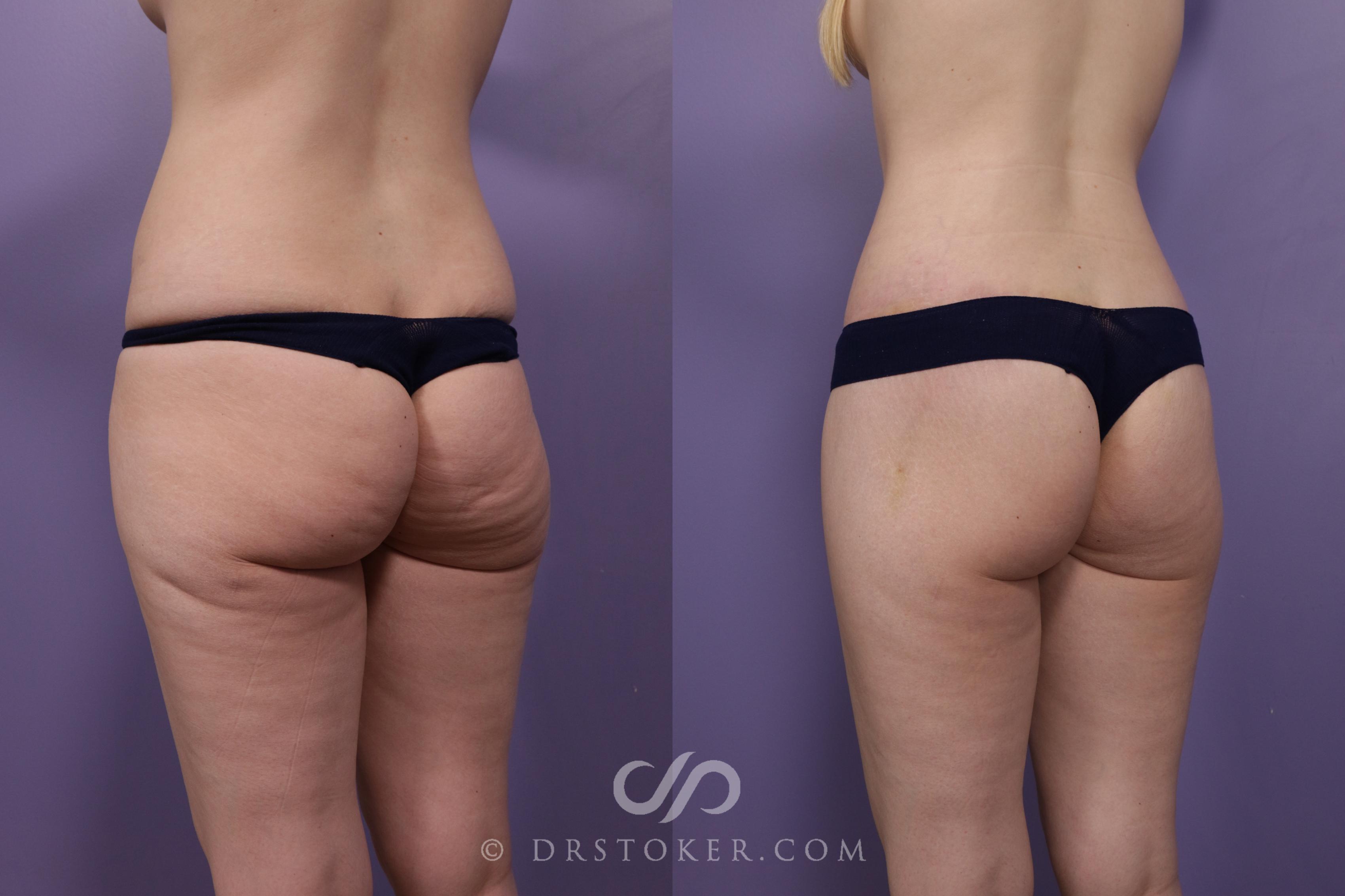 Before & After Bikini Body Lift ™ Case 2421 Left Oblique View in Los Angeles, CA