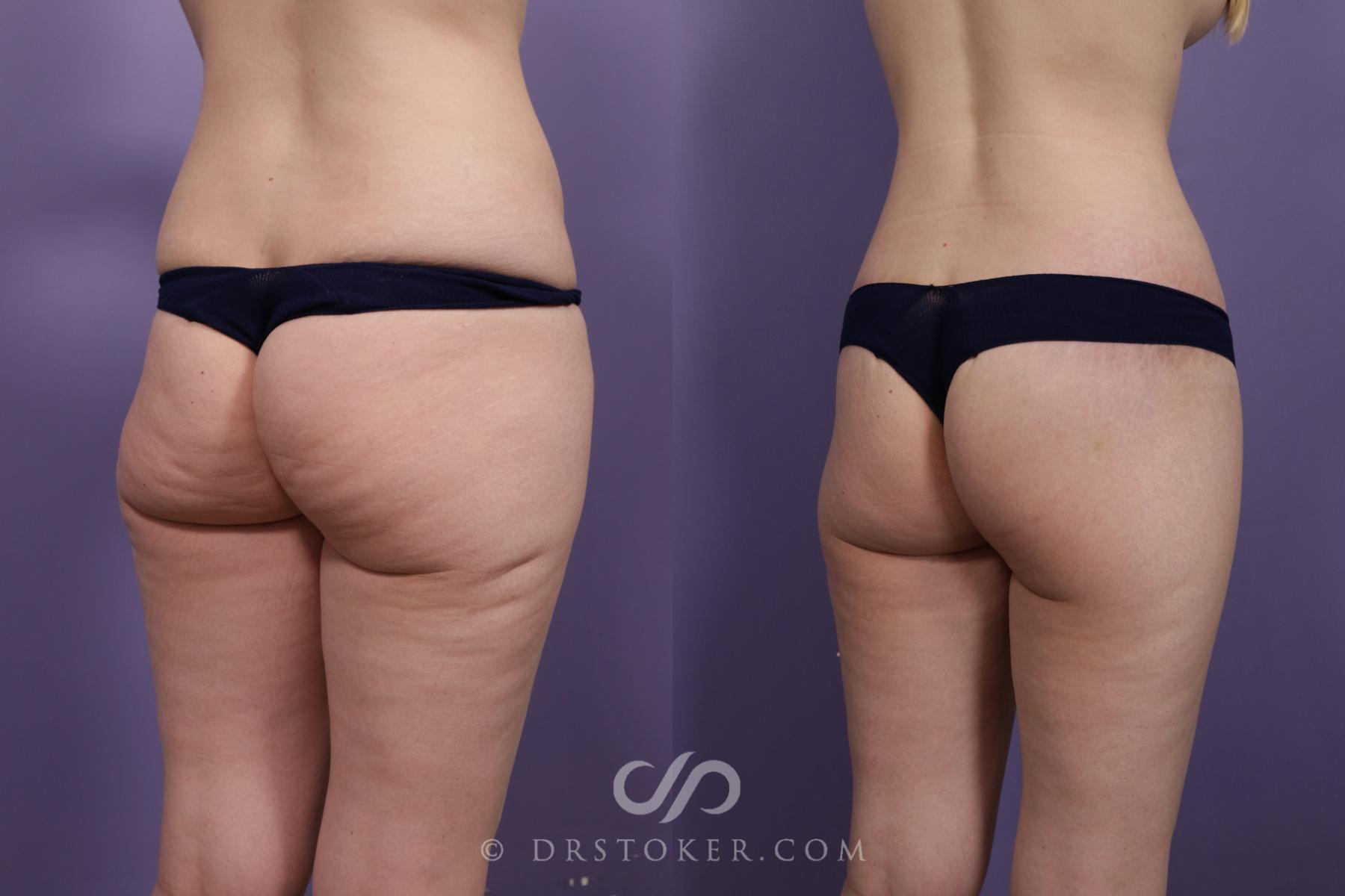 Before & After Bikini Body Lift ™ Case 2421 Right Oblique View in Los Angeles, CA