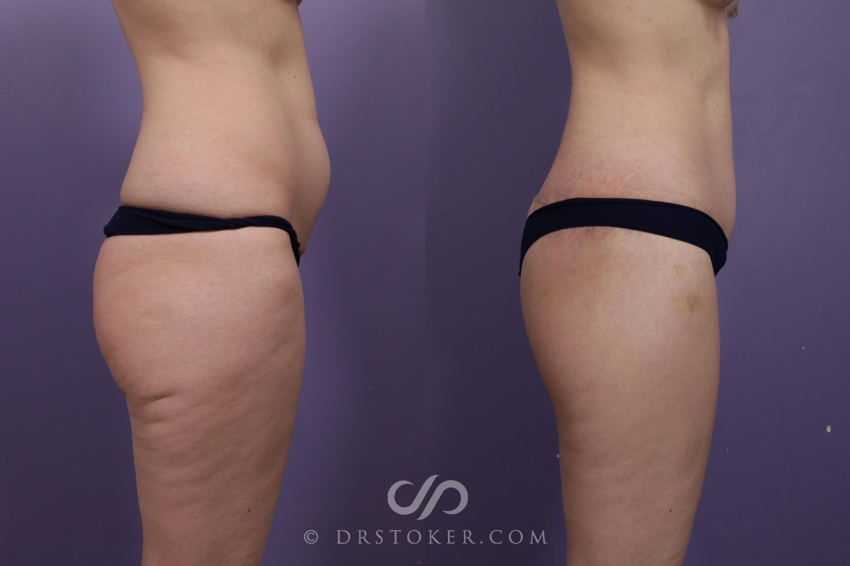 Before & After Bikini Body Lift ™ Case 2421 Right Side View in Los Angeles, CA