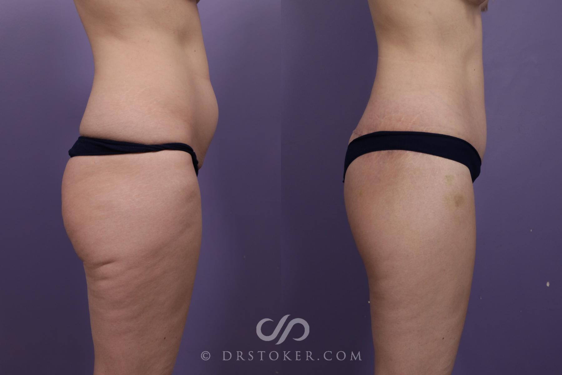 Before & After Bikini Body Lift ™ Case 2421 Right Side View in Los Angeles, CA