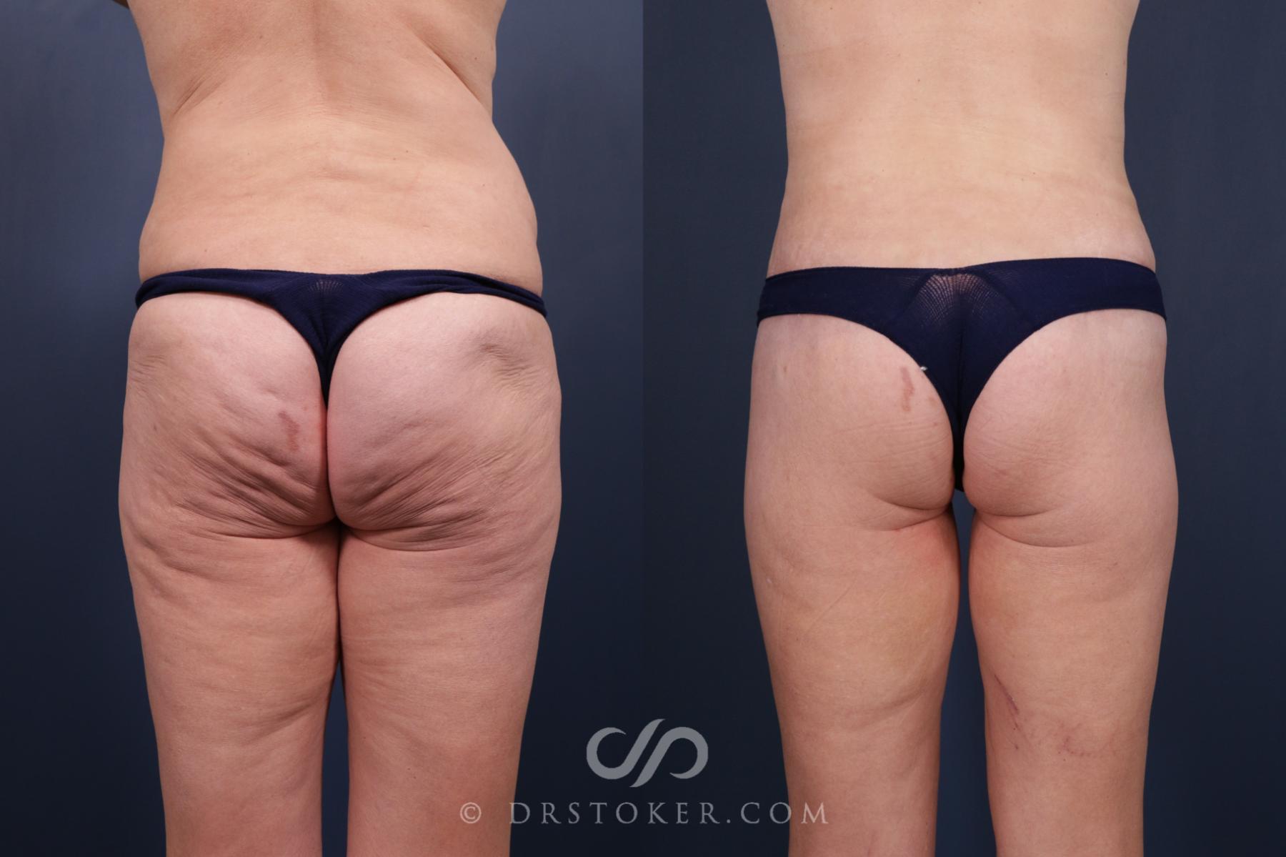 Before & After Bikini Body Lift ™ Case 2422 Back View in Los Angeles, CA