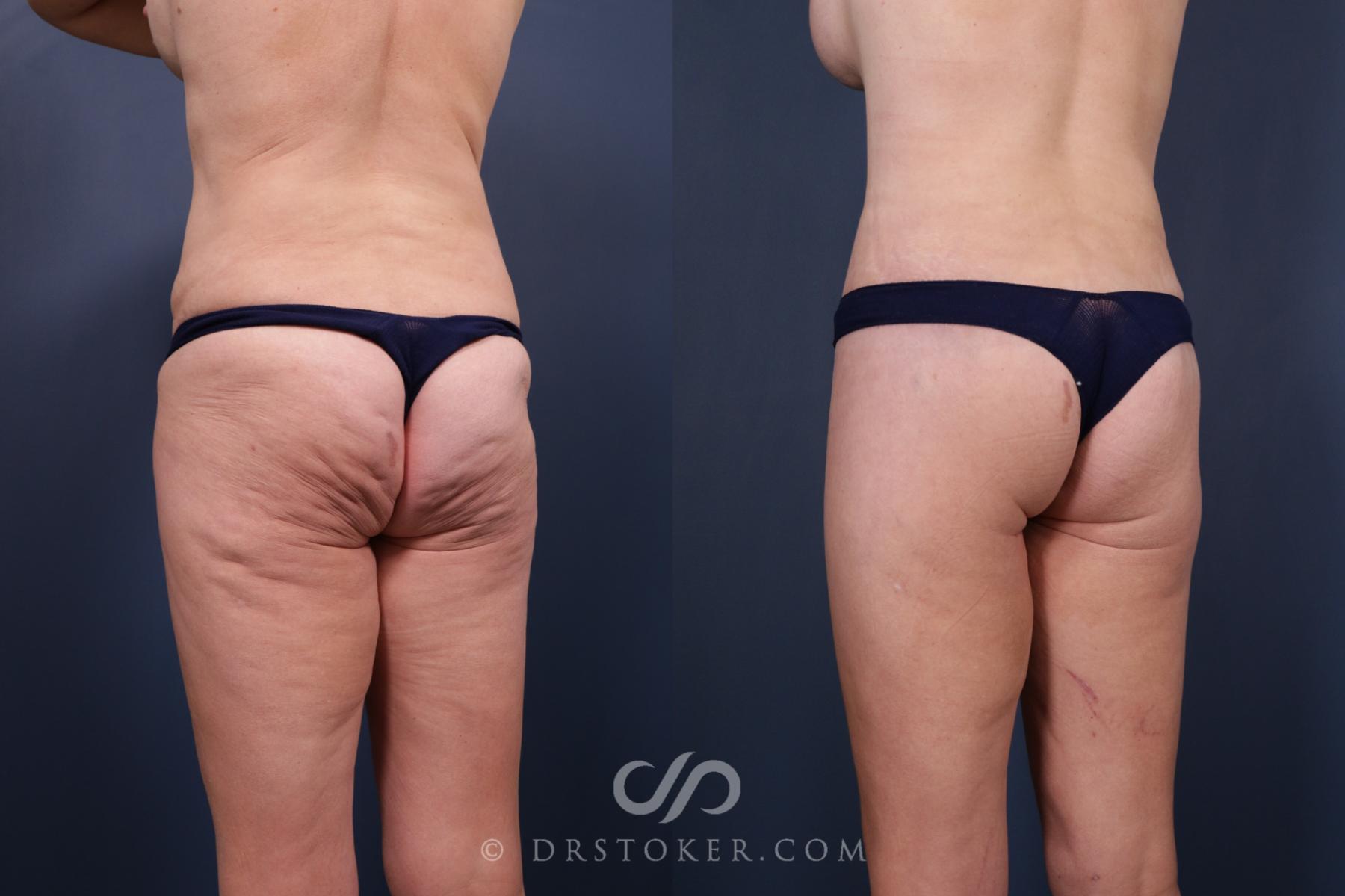 Before & After Bikini Body Lift ™ Case 2422 Left Oblique View in Los Angeles, CA