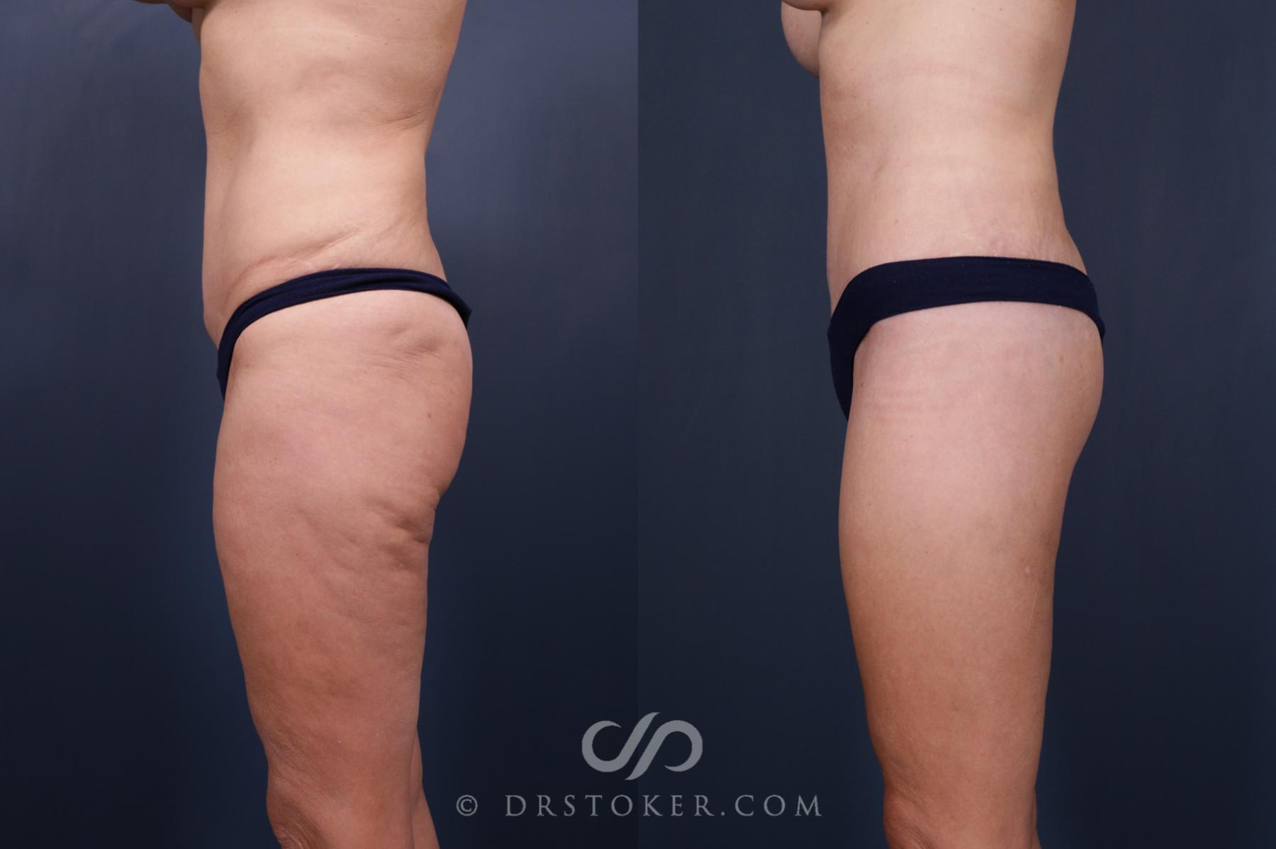 Before & After Bikini Body Lift ™ Case 2422 Left Side View in Los Angeles, CA
