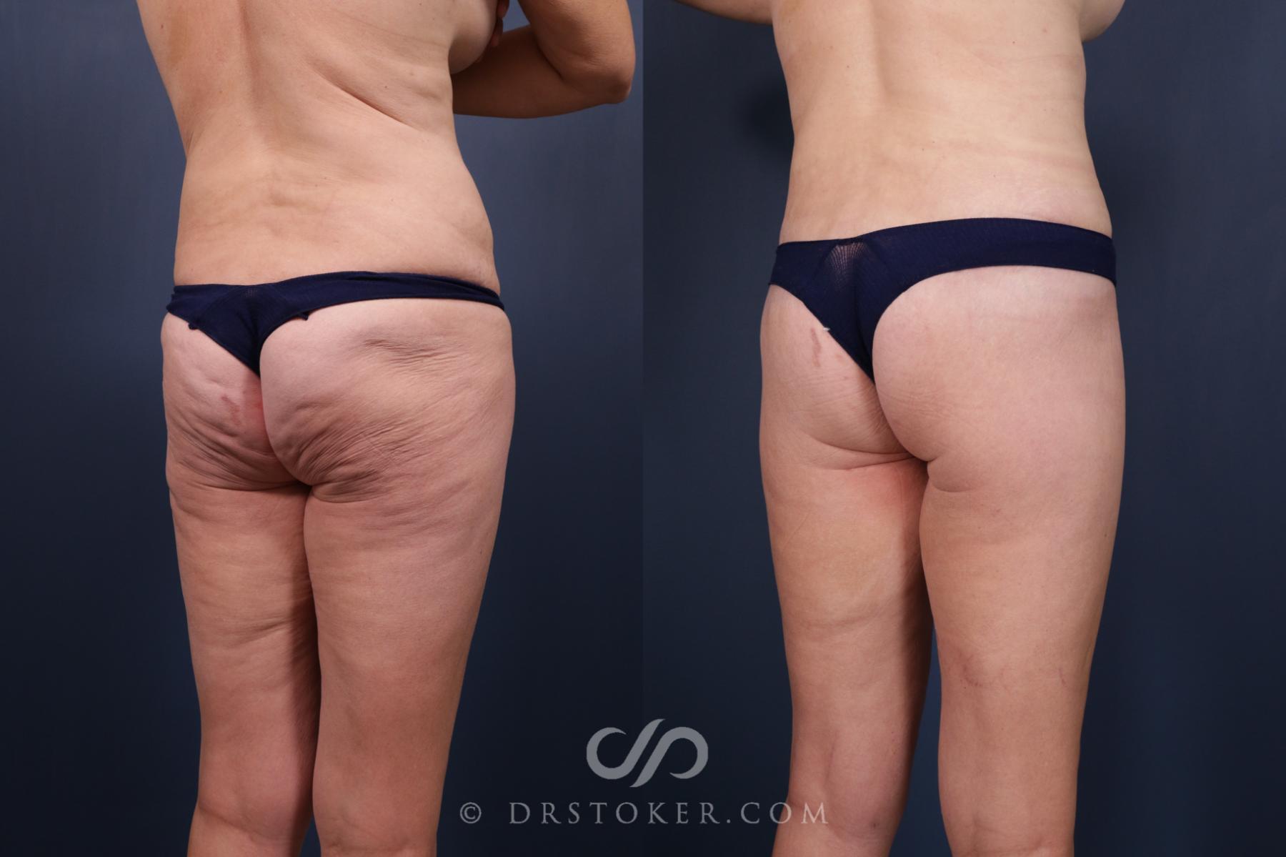 Before & After Bikini Body Lift ™ Case 2422 Right Oblique View in Los Angeles, CA