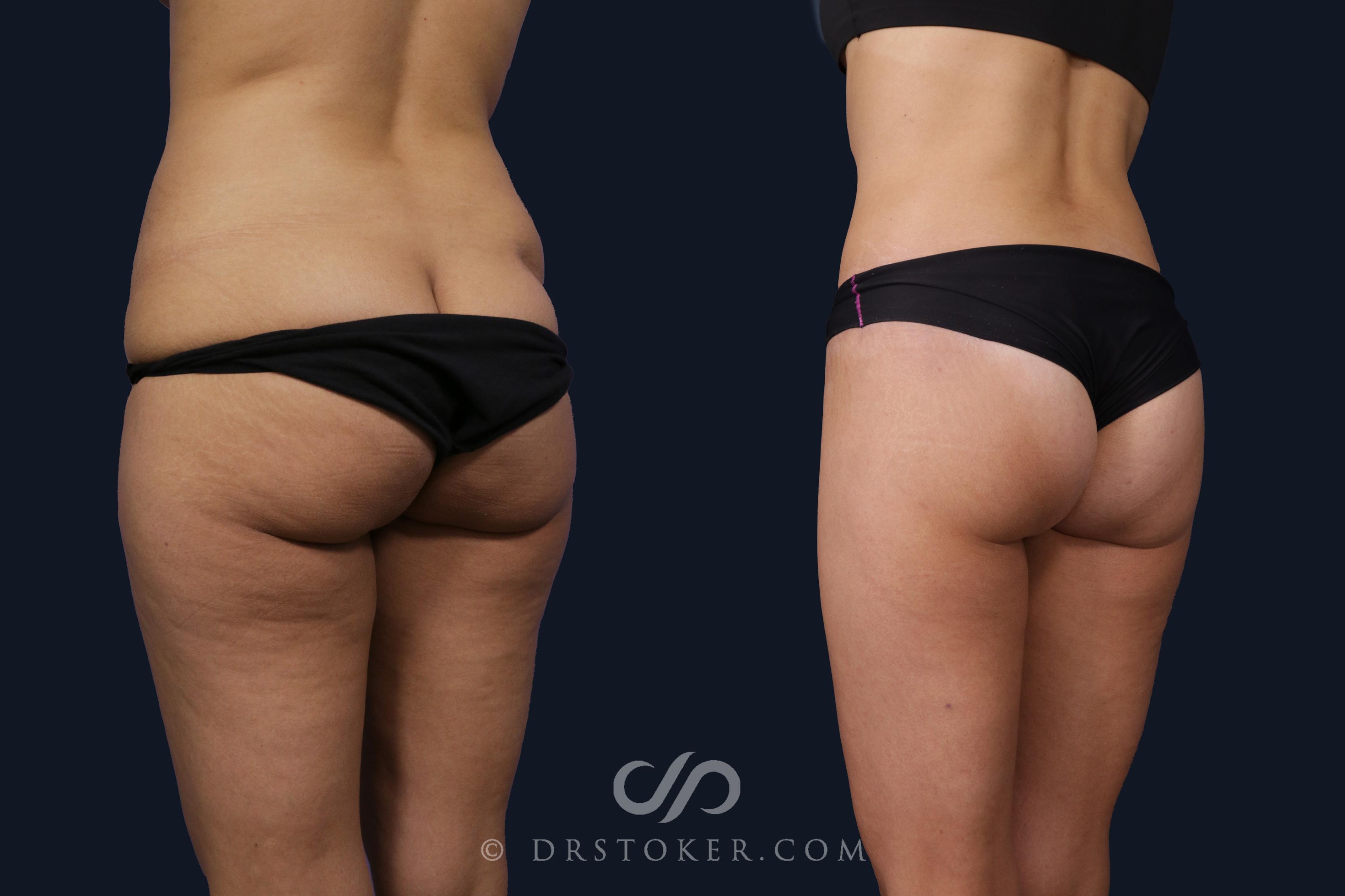 Before & After Bikini Body Lift ™ Case 2424 Left Oblique View in Los Angeles, CA