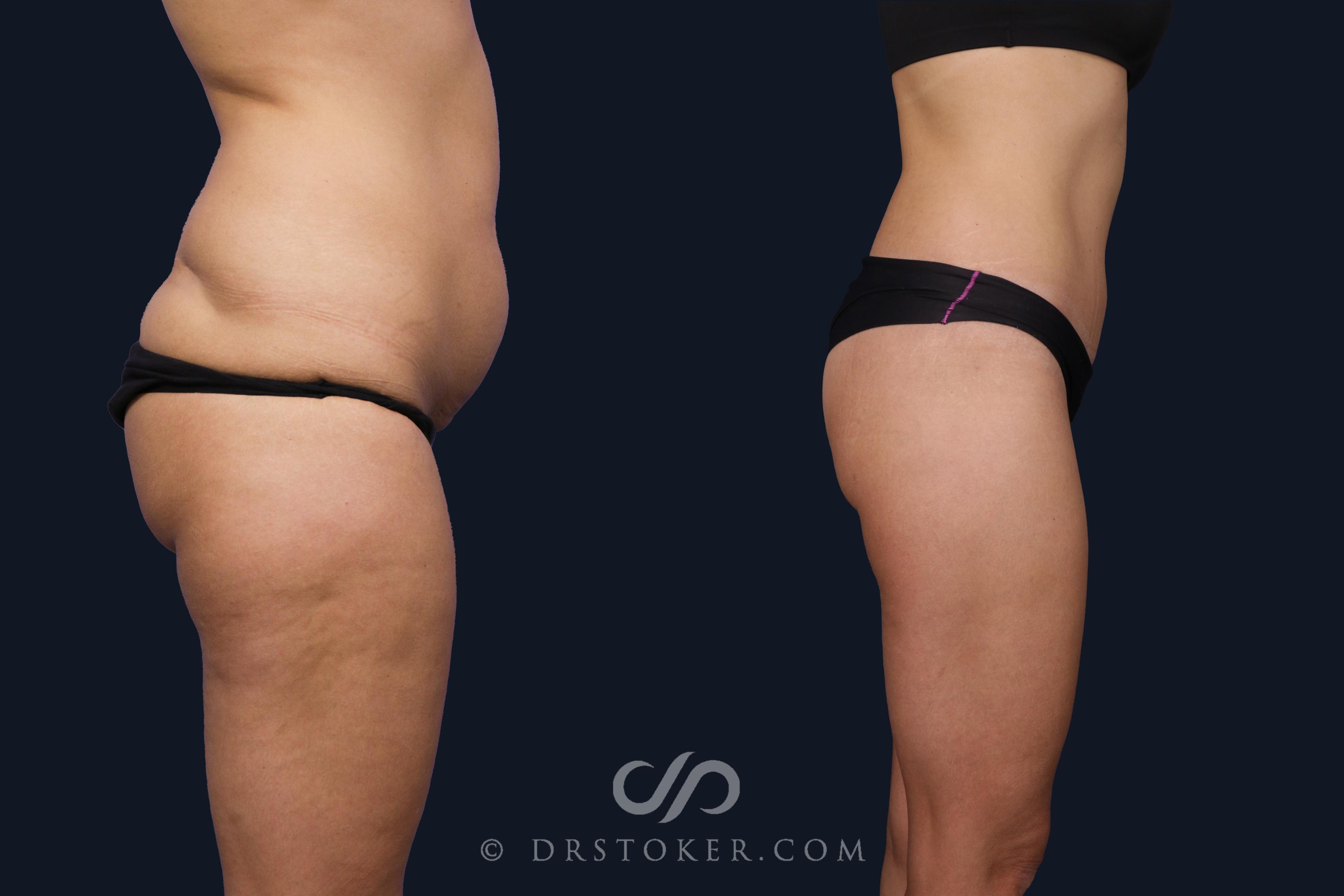 Before & After Bikini Body Lift ™ Case 2424 Right Side View in Los Angeles, CA