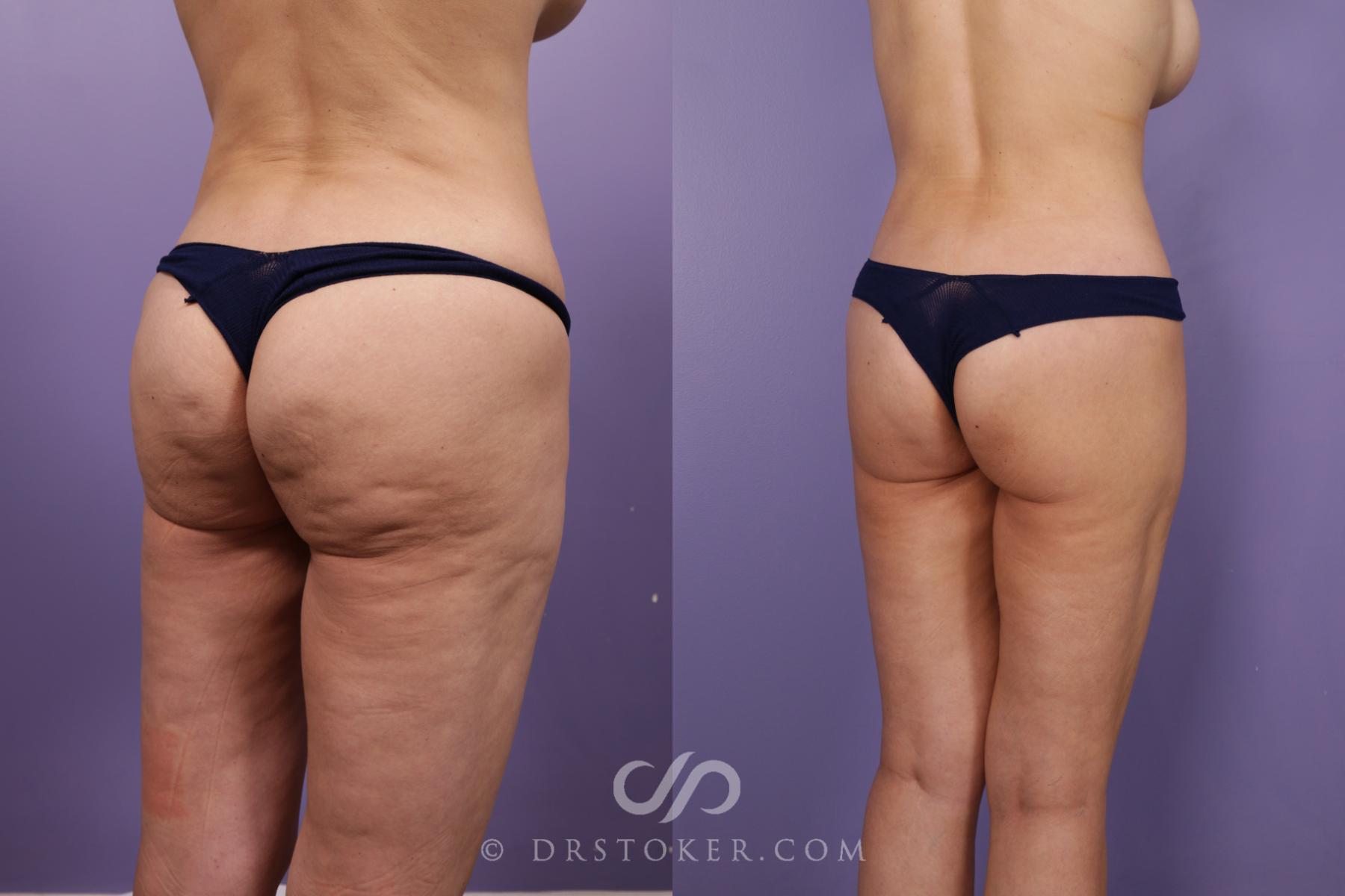 Before & After Bikini Body Lift ™ Case 2425 Right Oblique View in Los Angeles, CA