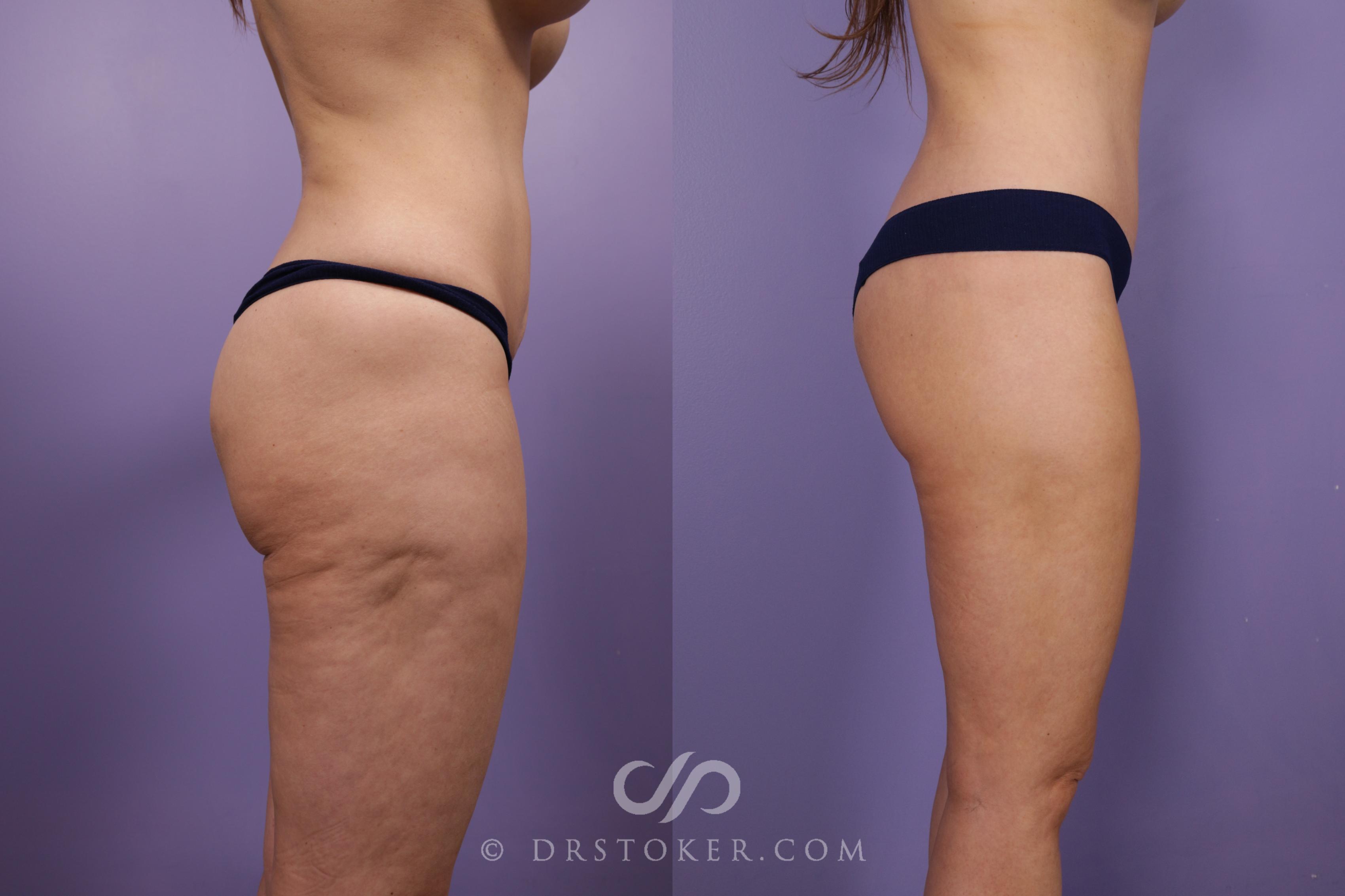 Before & After Bikini Body Lift ™ Case 2425 Right Side View in Los Angeles, CA